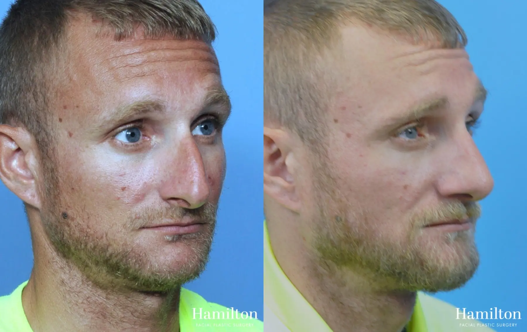 Rhinoplasty: Patient 31 - Before and After 2