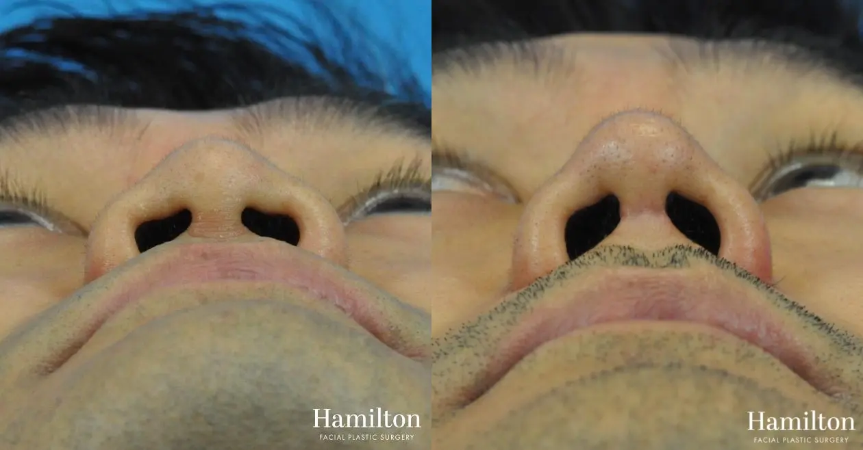 Rhinoplasty: Patient 23 - Before and After 6