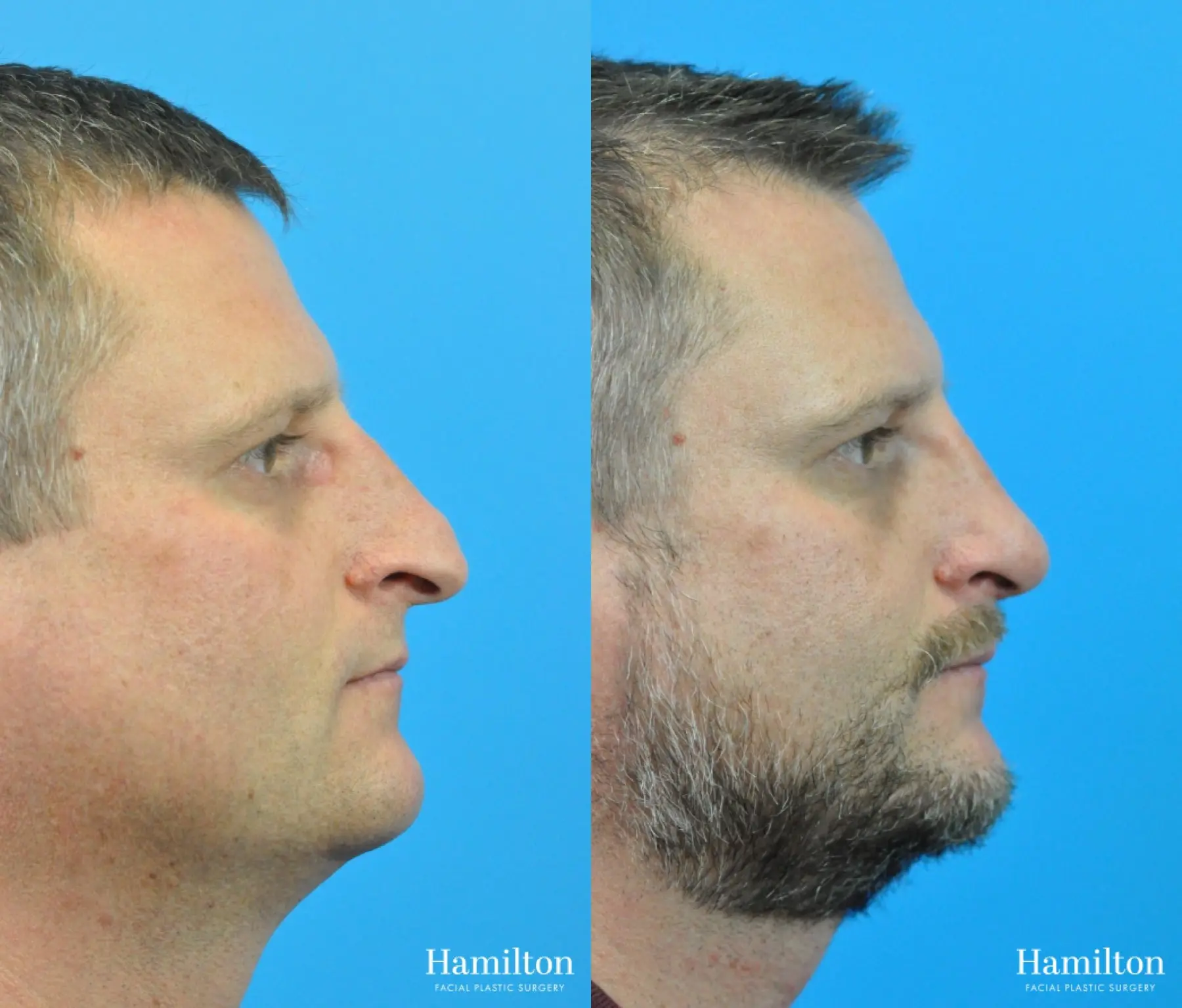 Rhinoplasty: Patient 27 - Before and After 1