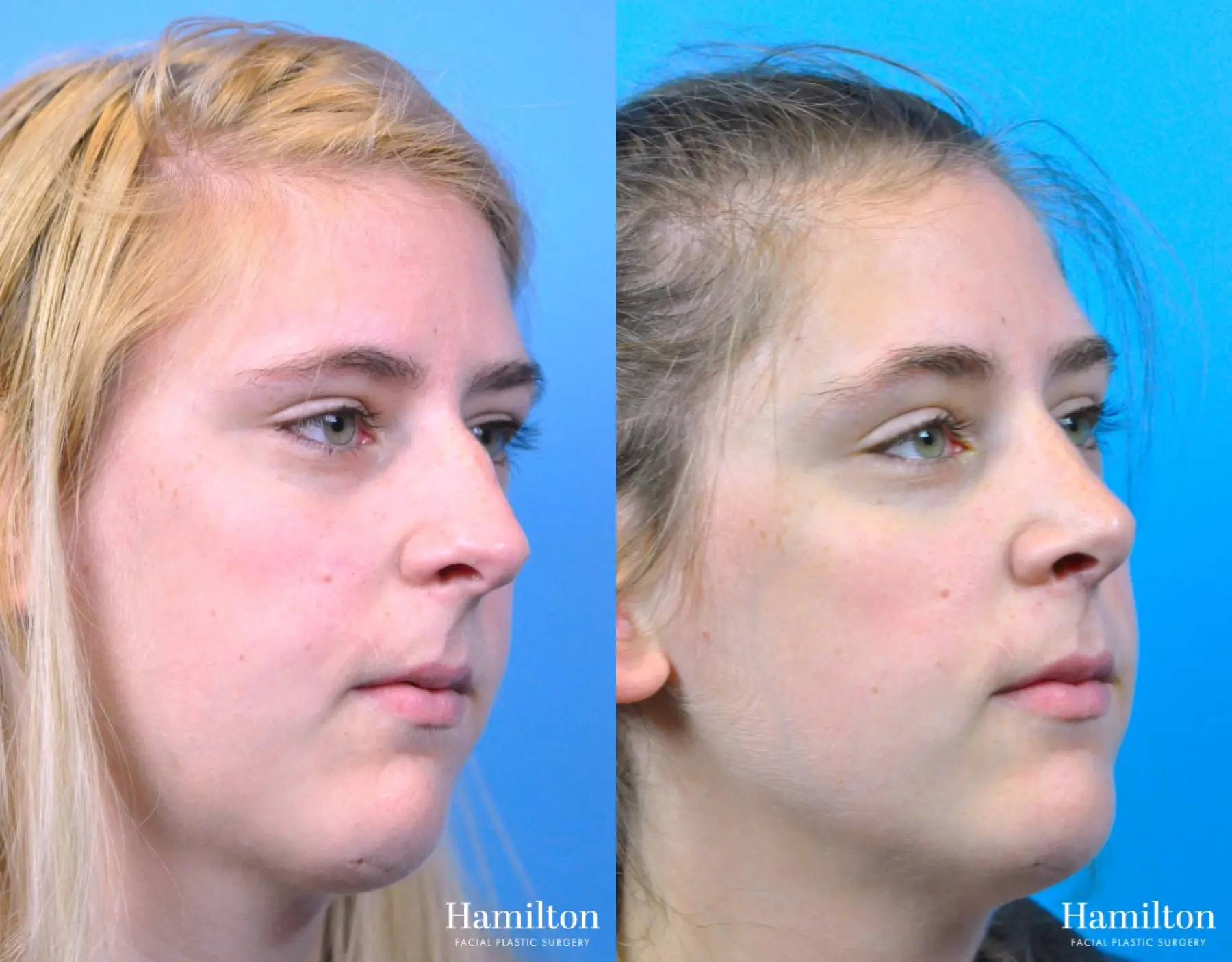 Rhinoplasty: Patient 48 - Before and After 3