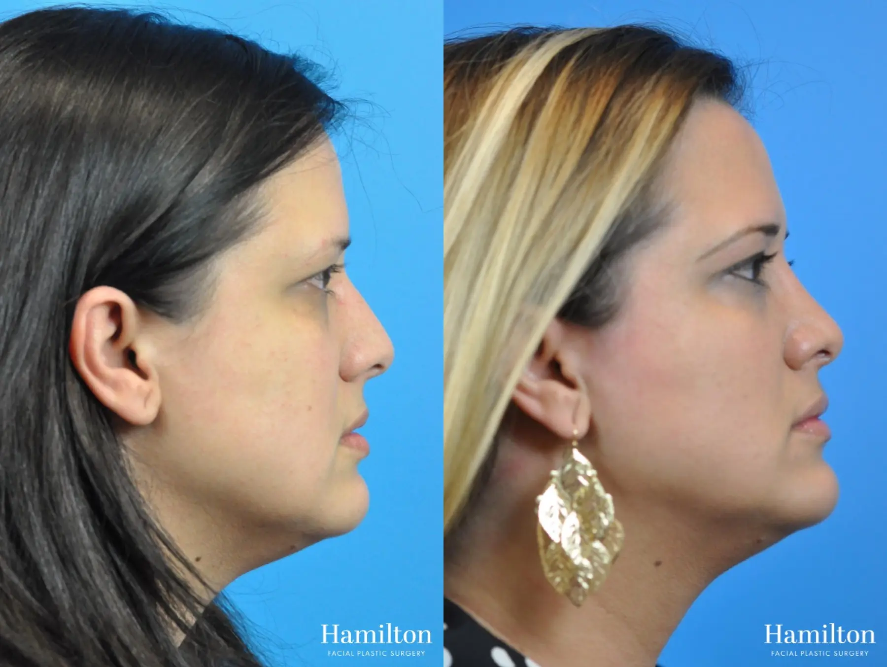 Rhinoplasty: Patient 36 - Before and After 2