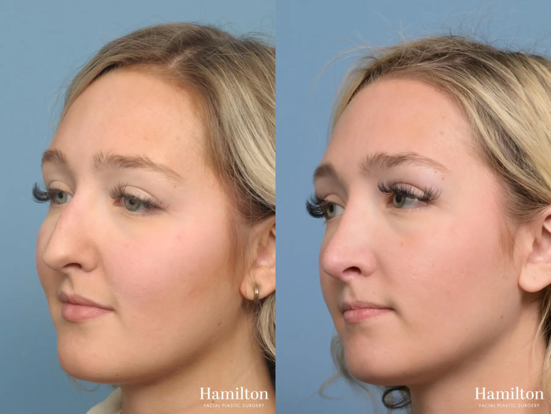 Rhinoplasty: Patient 6 - Before and After 2