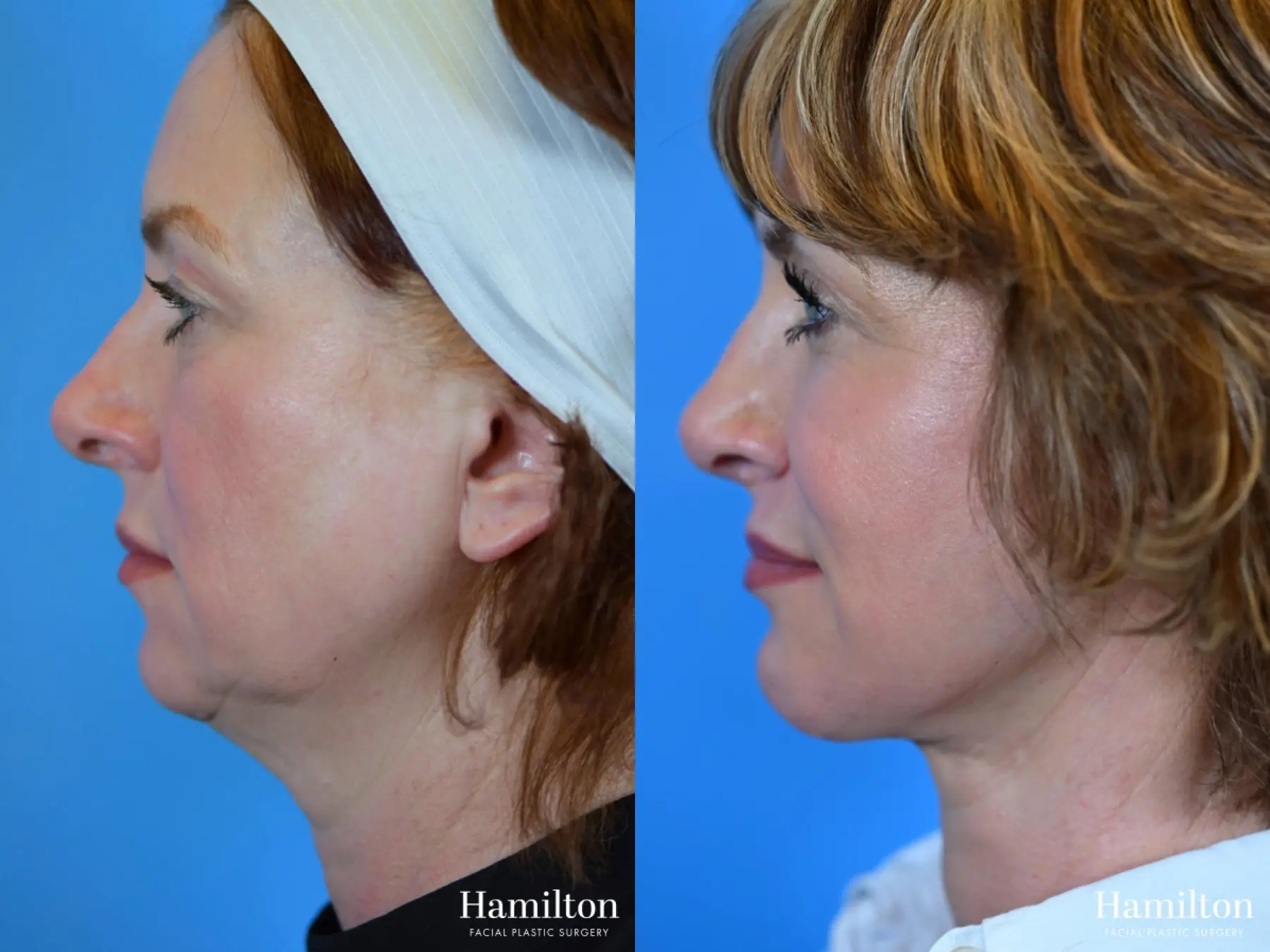 Rhinoplasty: Patient 26 - Before and After 3