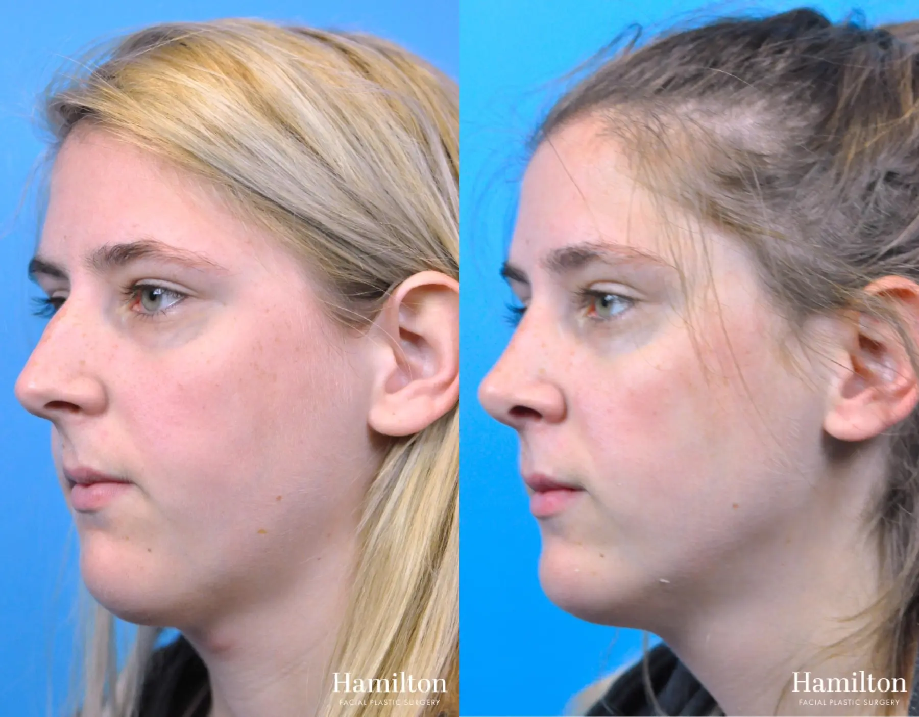 Rhinoplasty: Patient 48 - Before and After 2