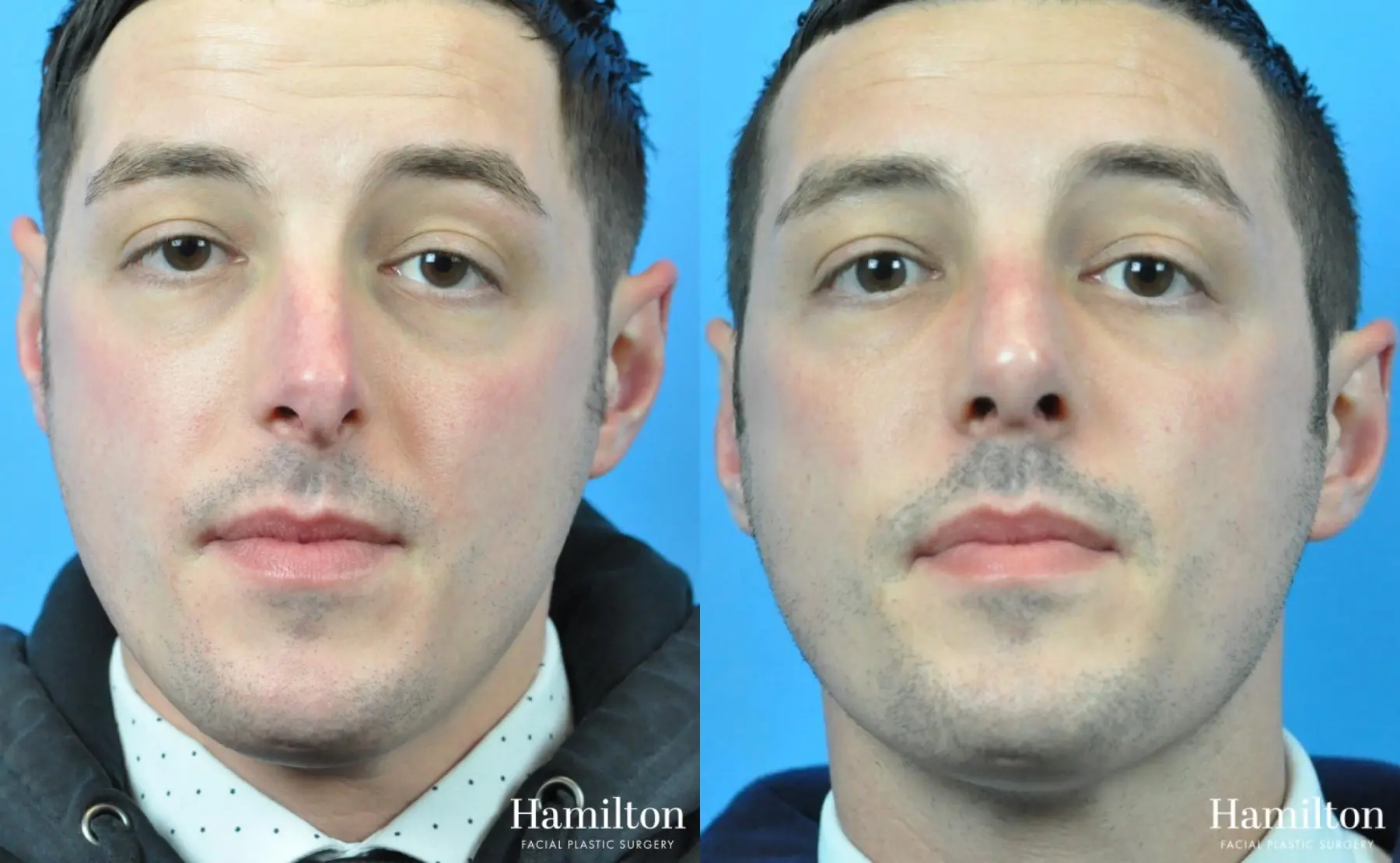 Rhinoplasty: Patient 35 - Before and After 1