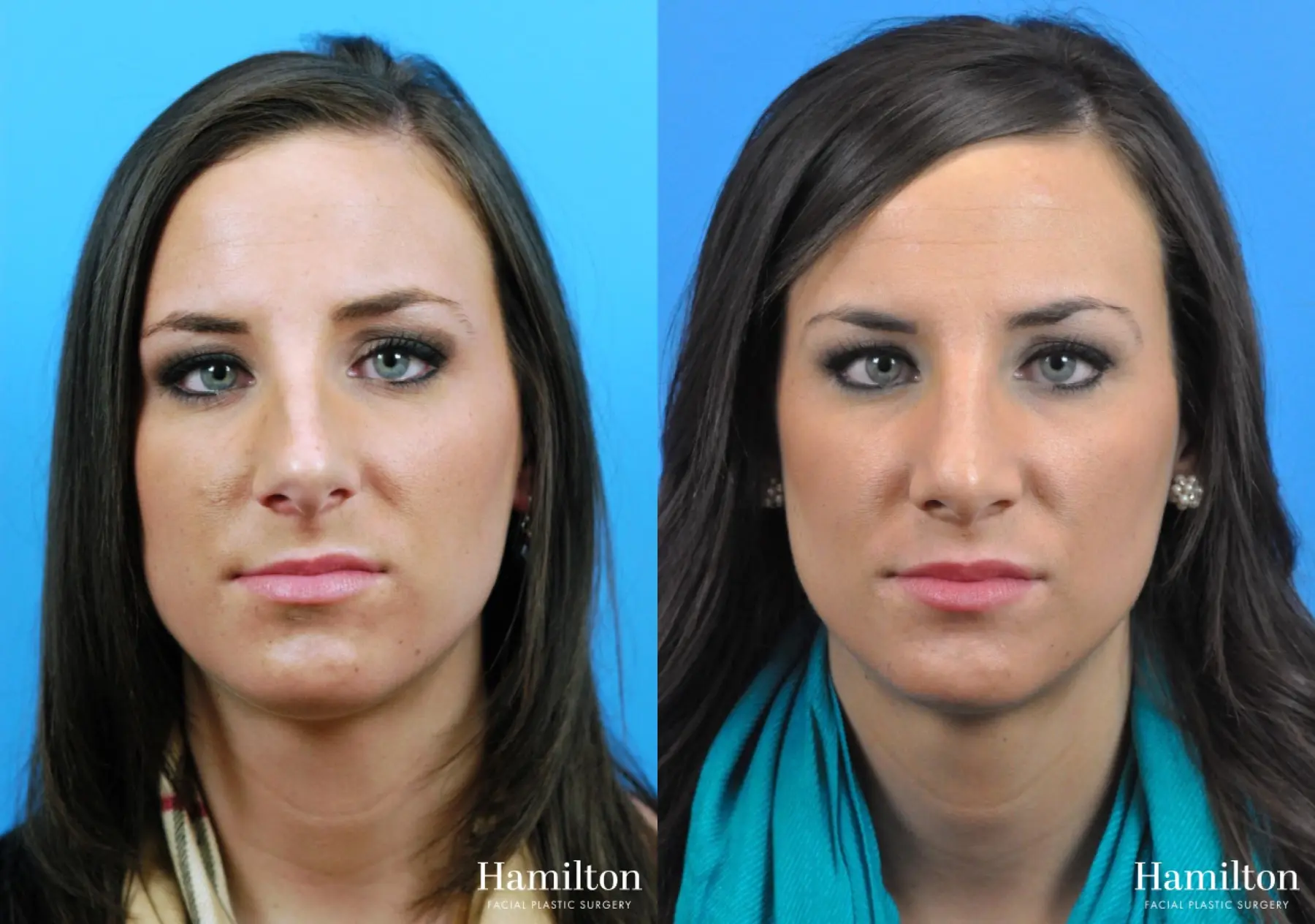 Rhinoplasty: Patient 24 - Before and After 4