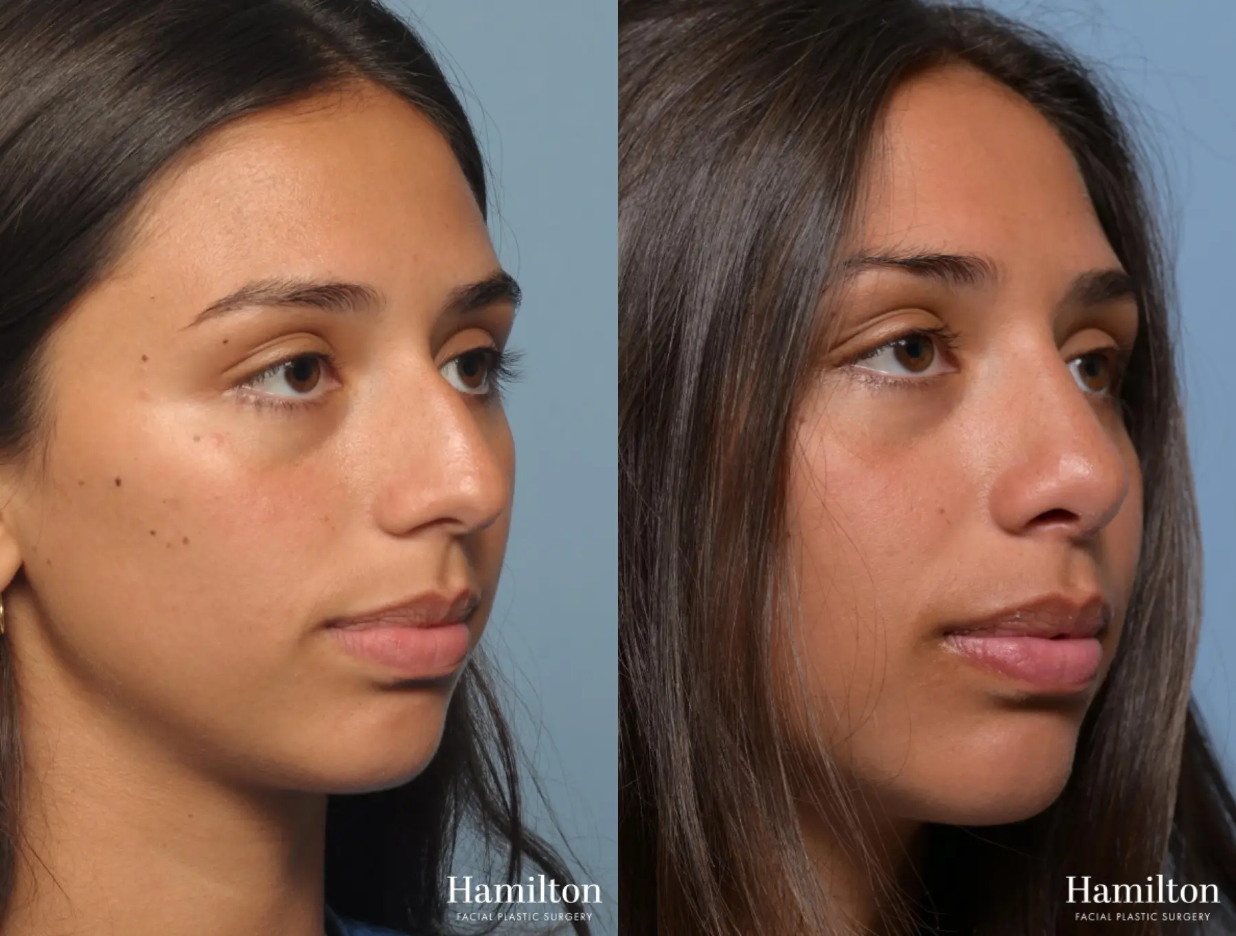 Rhinoplasty: Patient 4 - Before and After 4