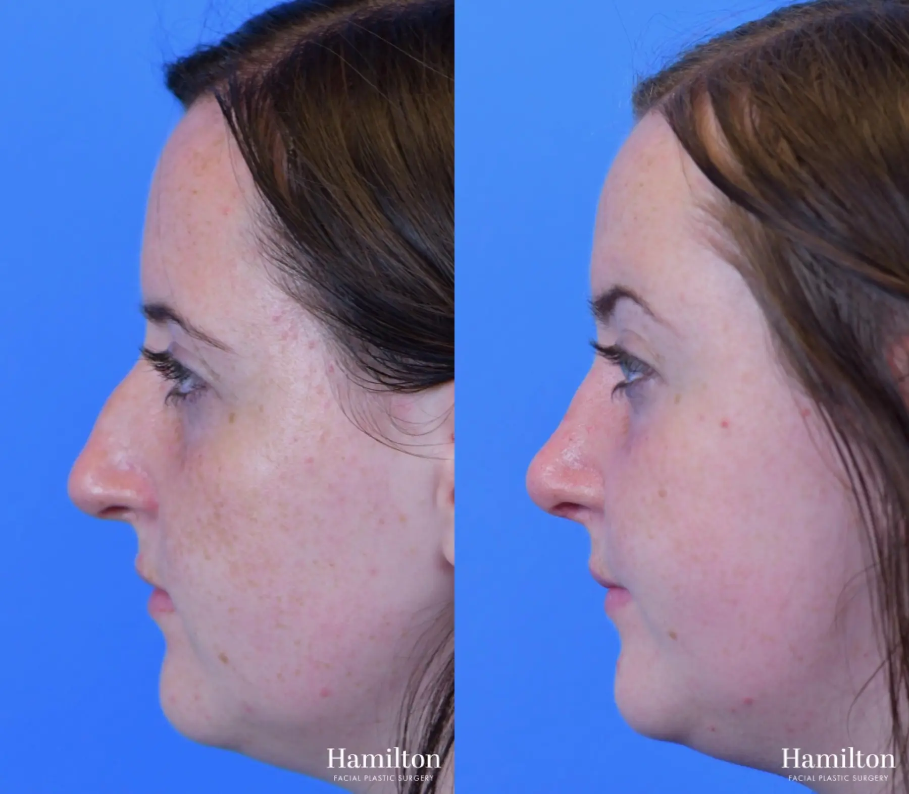 Rhinoplasty: Patient 42 - Before and After 1