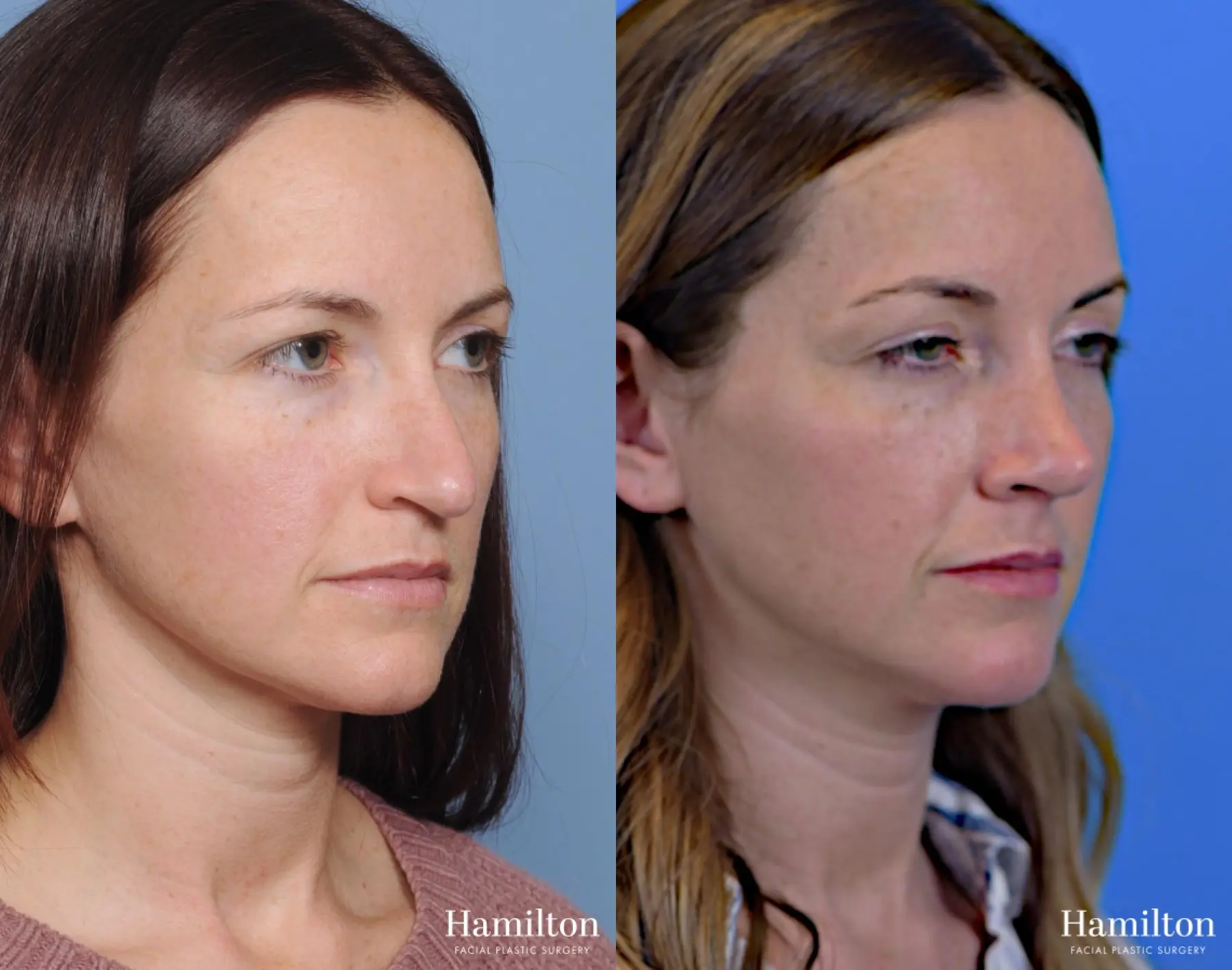 Rhinoplasty: Patient 7 - Before and After 2