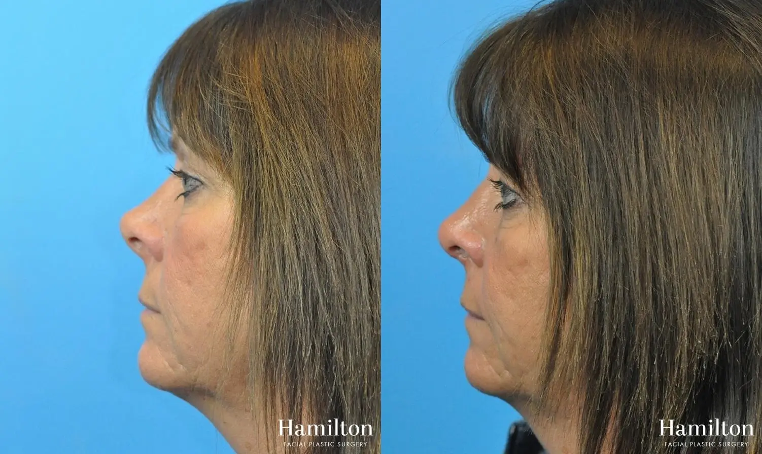 Rhinoplasty: Patient 46 - Before and After 2