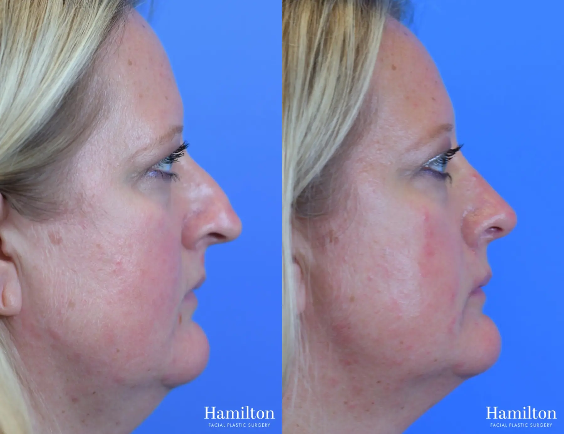 Rhinoplasty: Patient 33 - Before and After 1