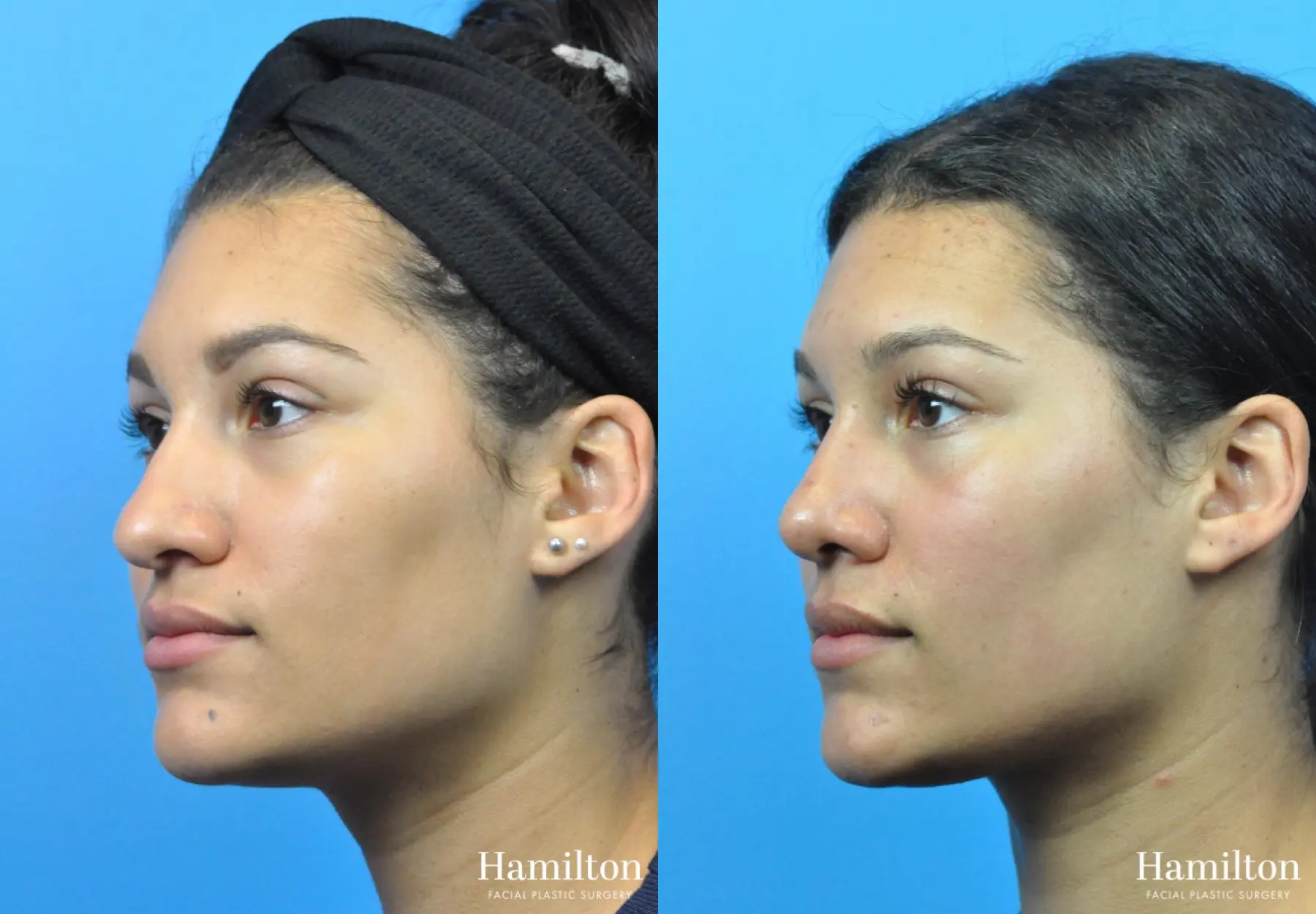 Rhinoplasty: Patient 43 - Before and After 4