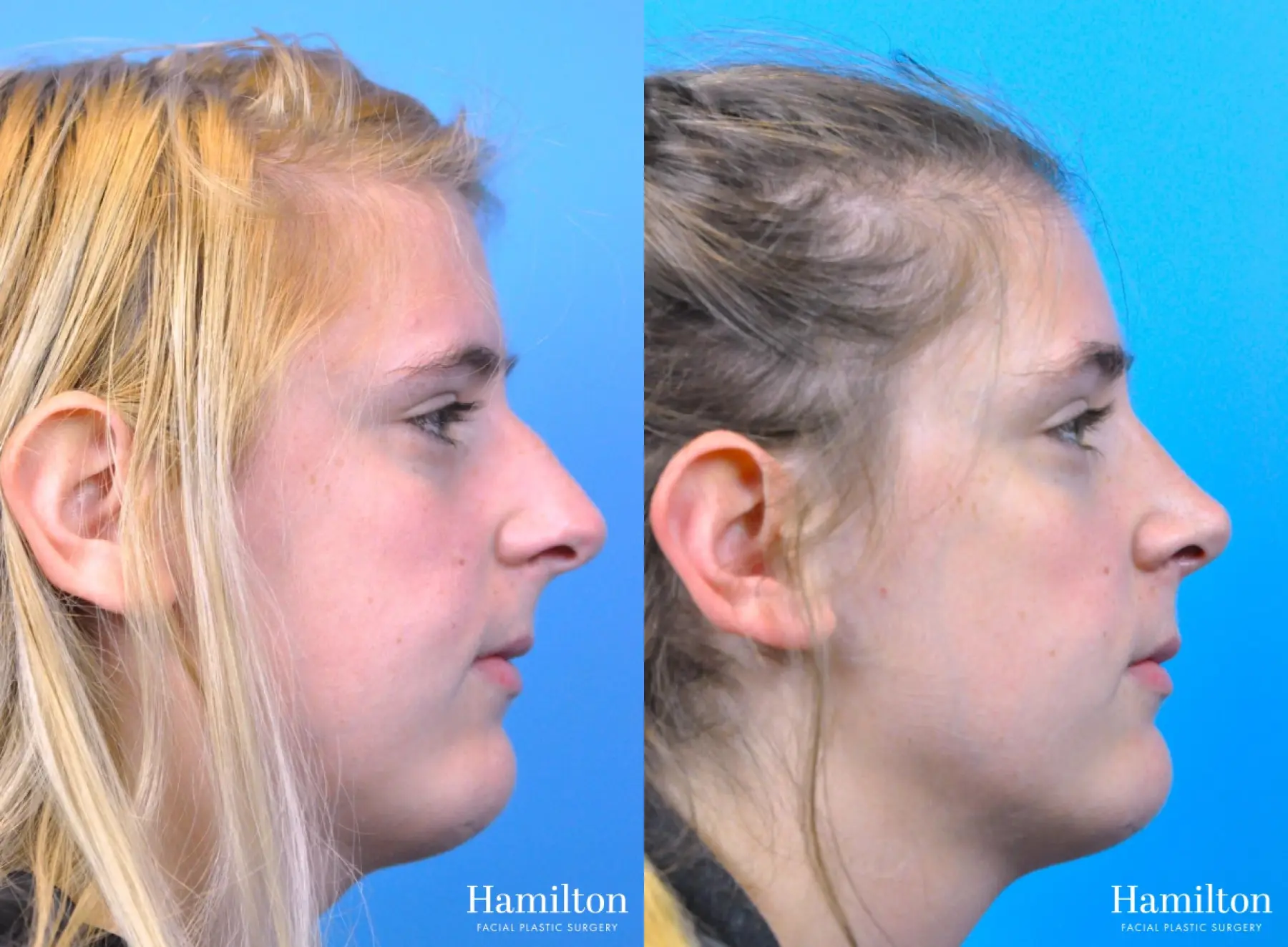 Rhinoplasty: Patient 48 - Before and After 1