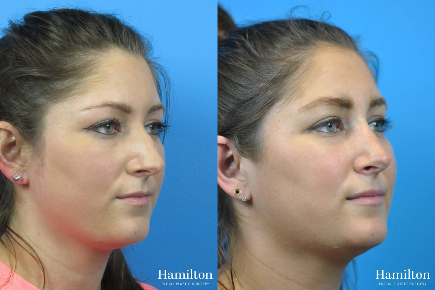 Rhinoplasty: Patient 32 - Before and After 4