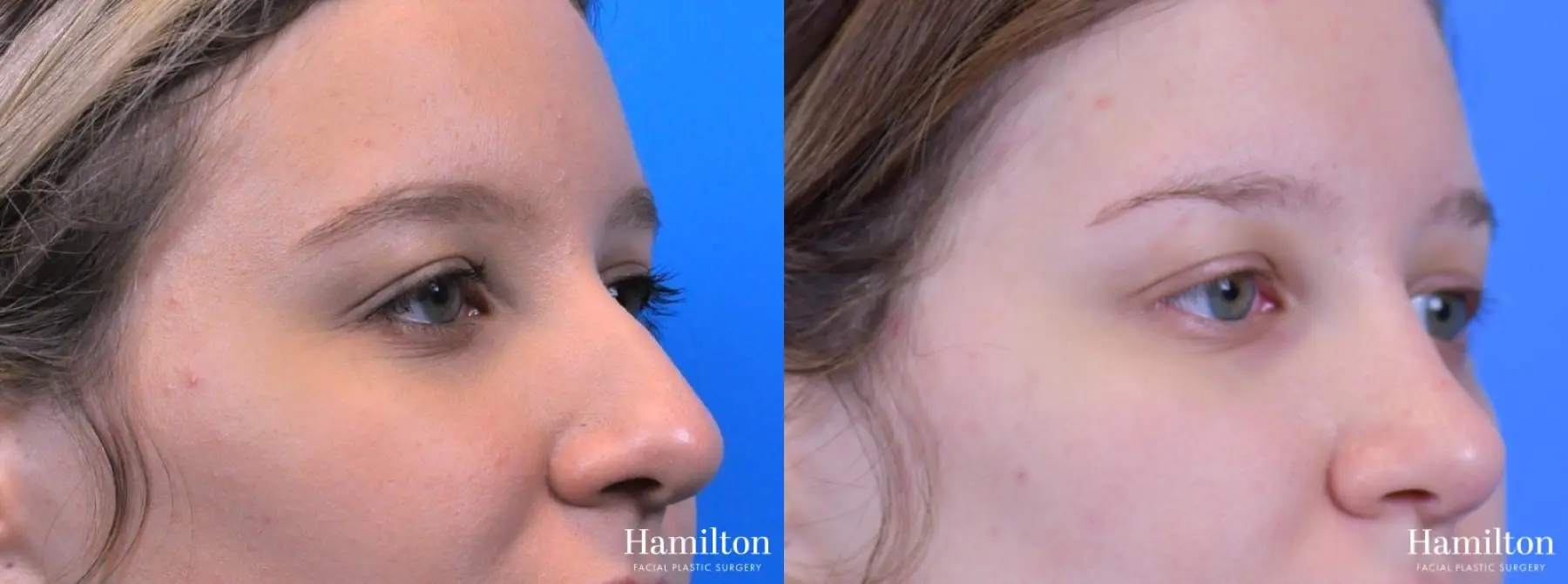 Rhinoplasty: Patient 18 - Before and After 3