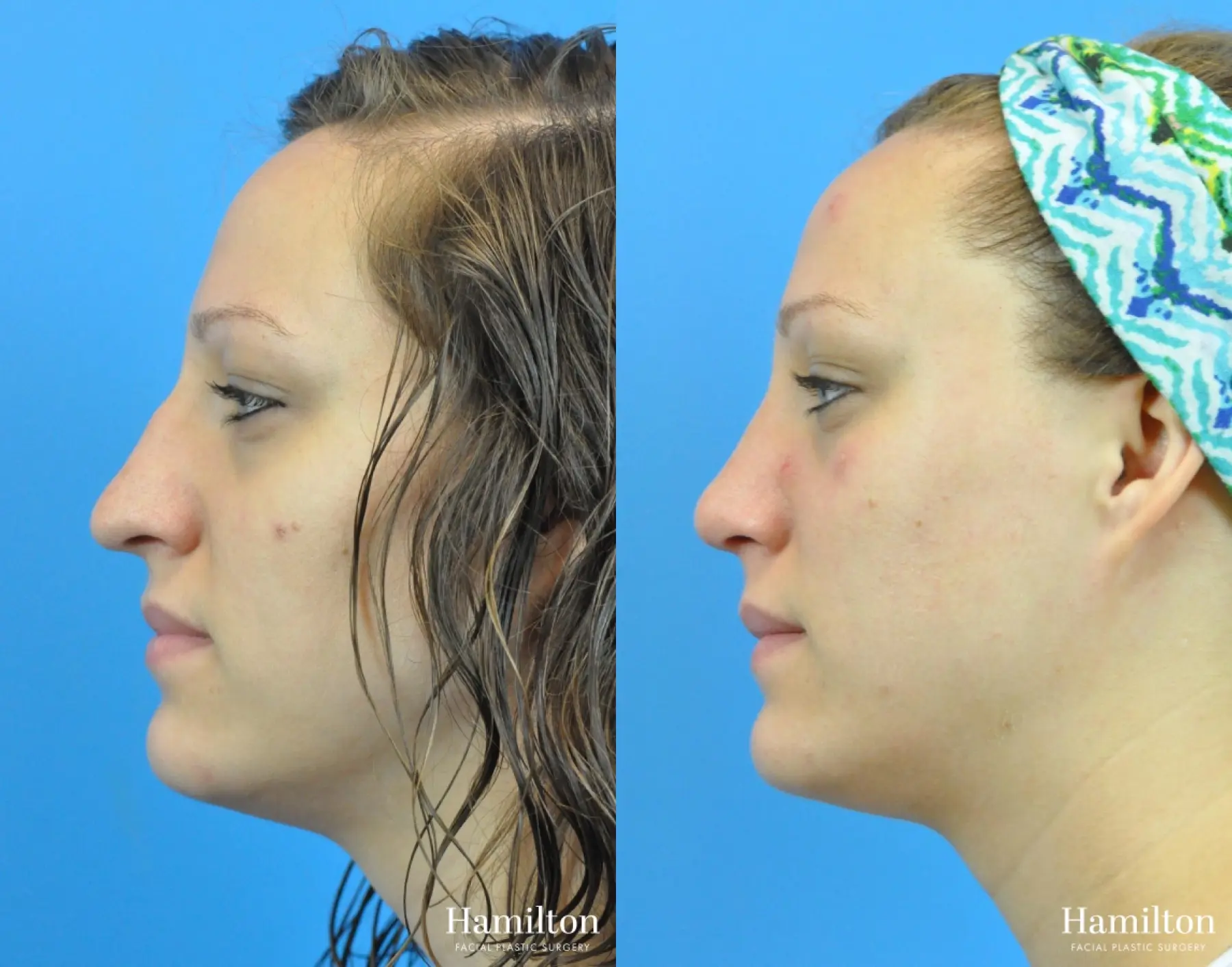 Rhinoplasty: Patient 49 - Before and After 1