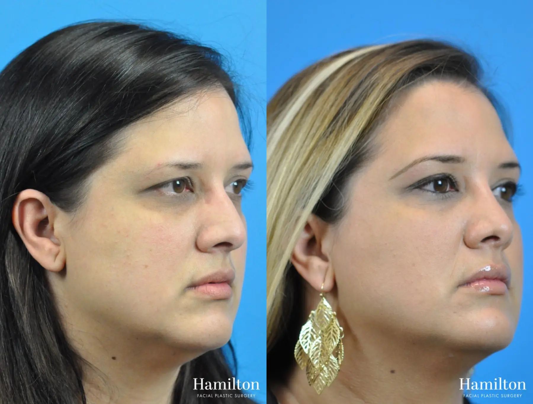 Rhinoplasty: Patient 36 - Before and After 1