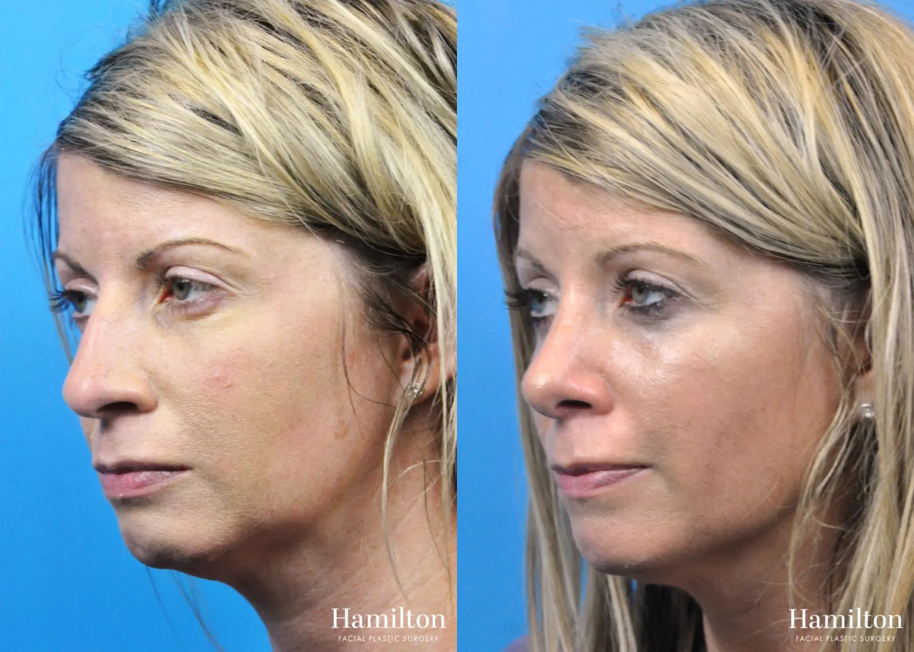 Rhinoplasty: Patient 32 - Before and After 2