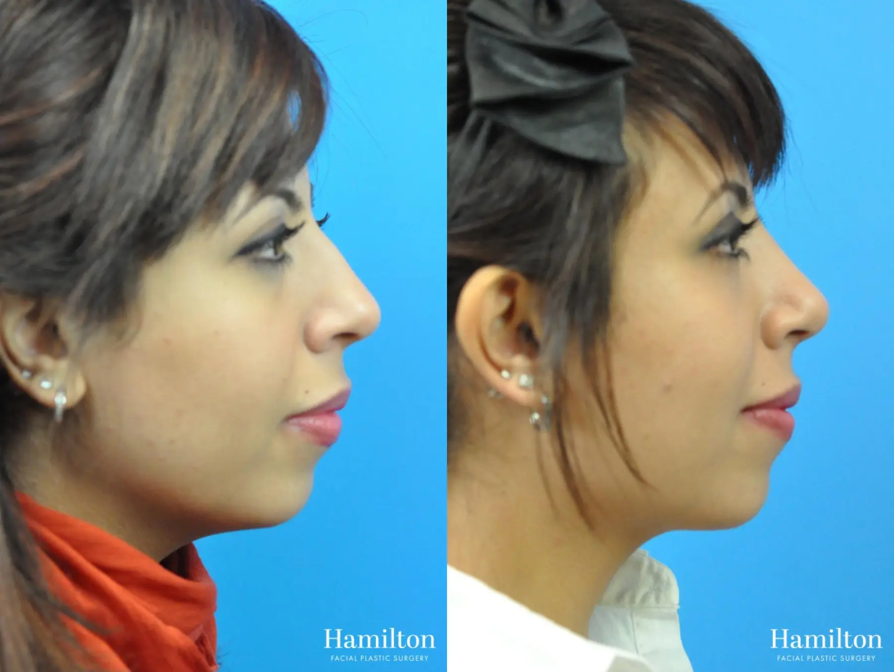 Rhinoplasty: Patient 16 - Before and After 3