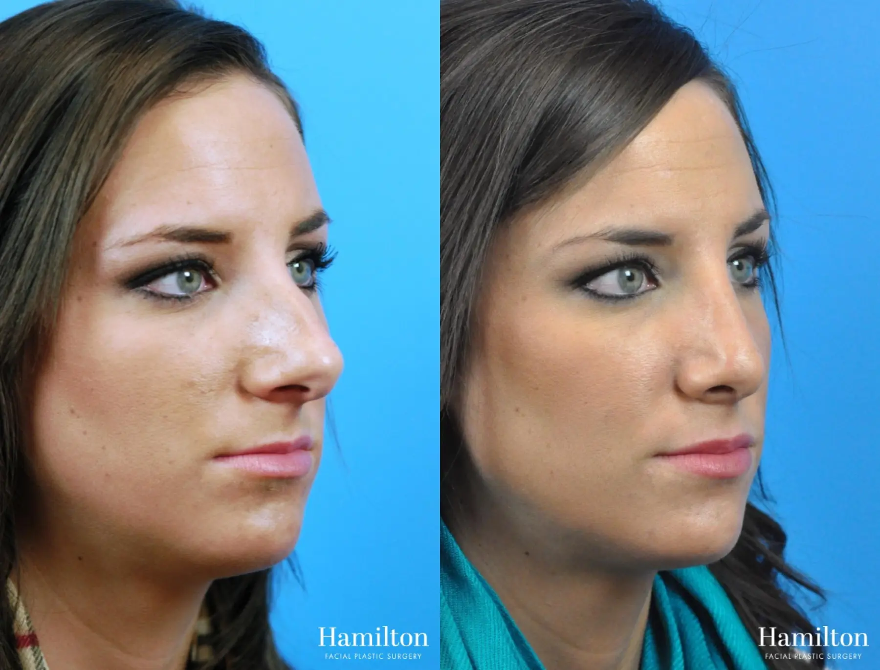 Rhinoplasty: Patient 24 - Before and After 3