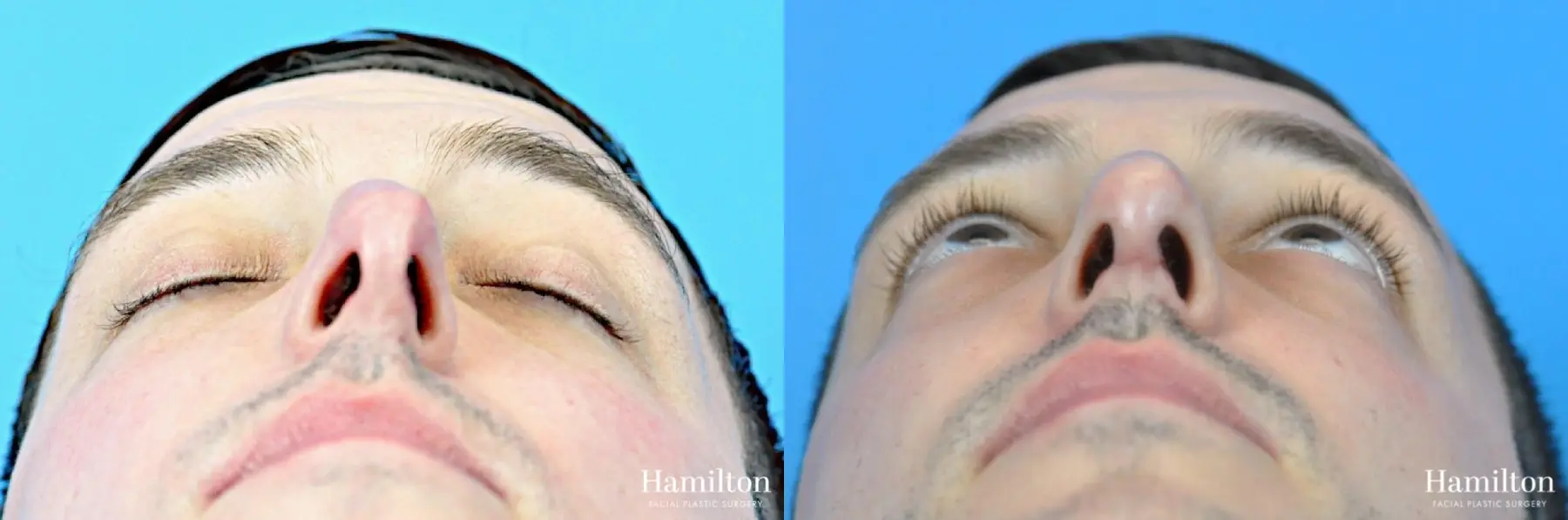 Rhinoplasty: Patient 35 - Before and After 2