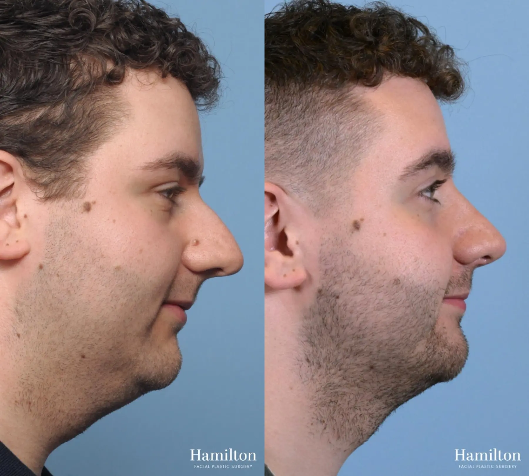 Rhinoplasty: Patient 9 - Before and After 2