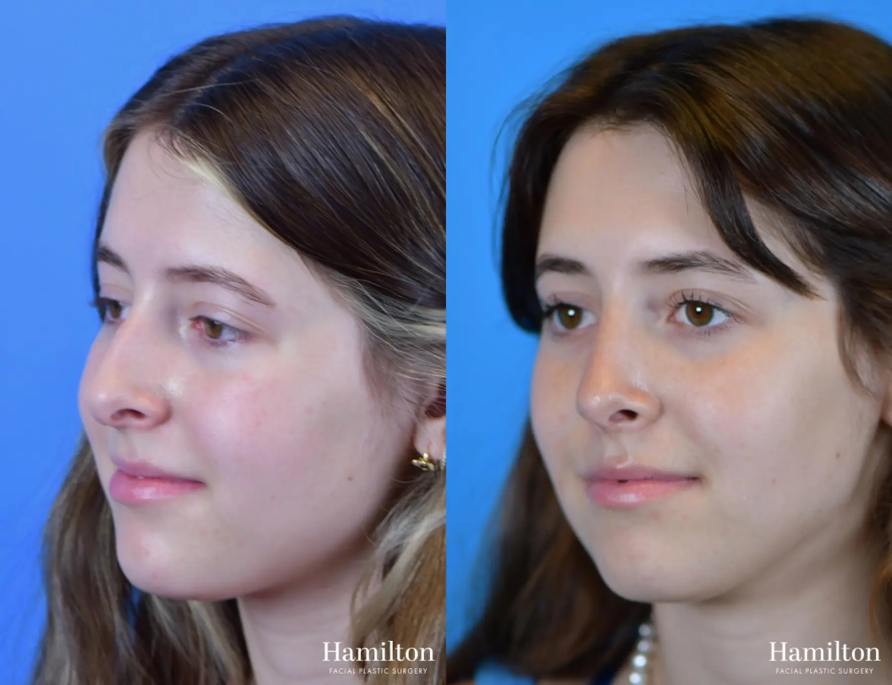 Rhinoplasty: Patient 41 - Before and After 4