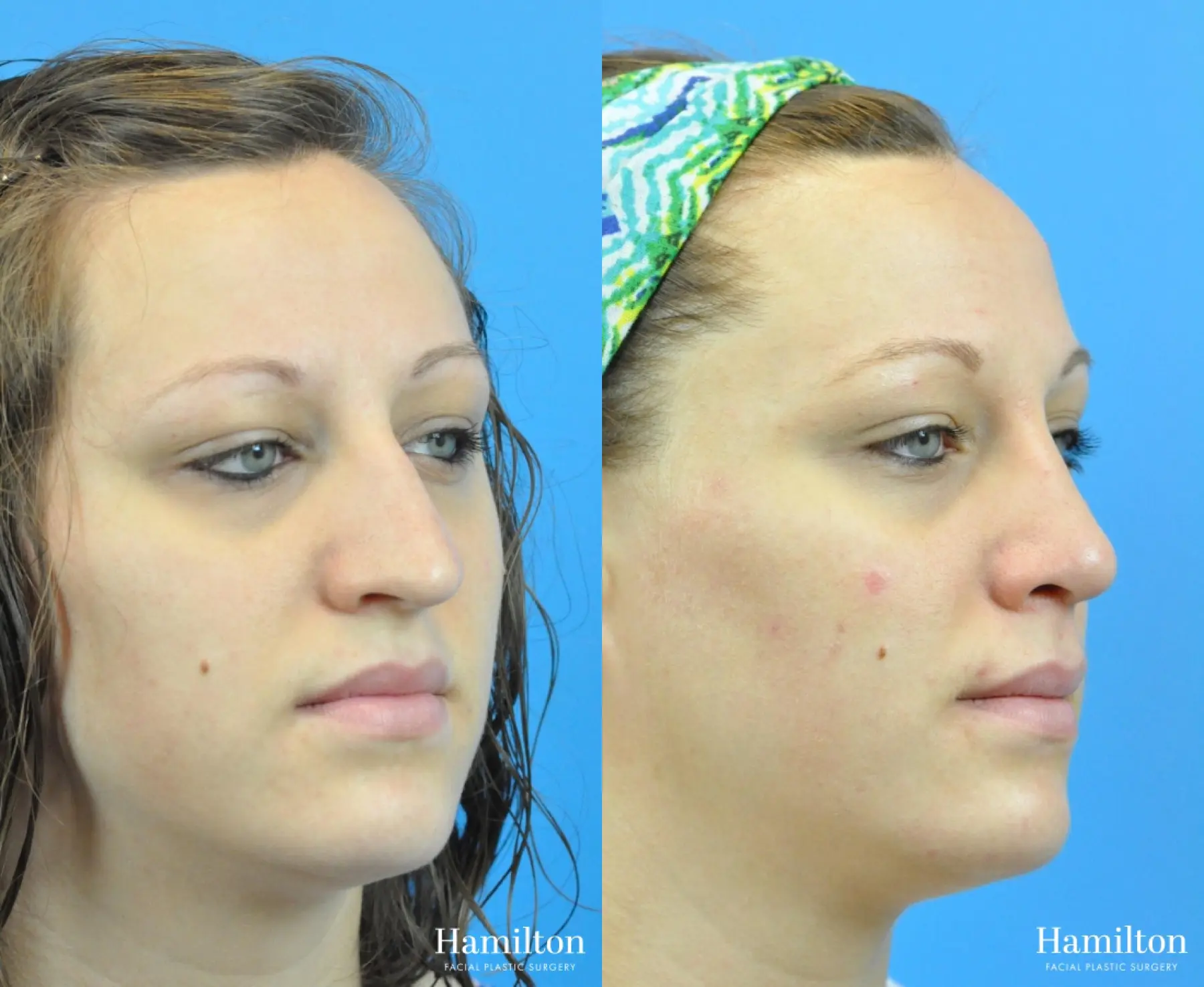 Rhinoplasty: Patient 49 - Before and After 2