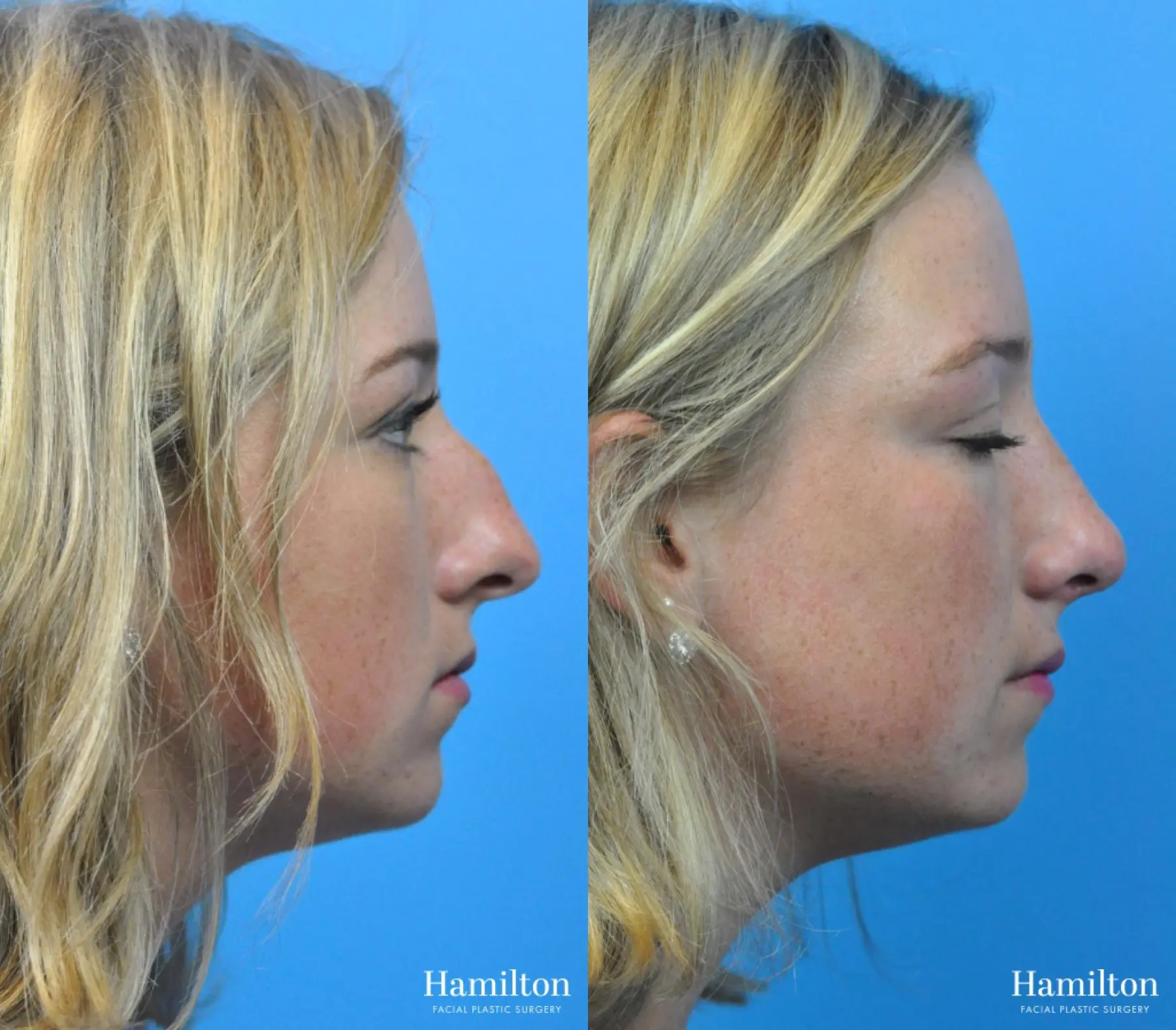 Rhinoplasty: Patient 31 - Before and After 2