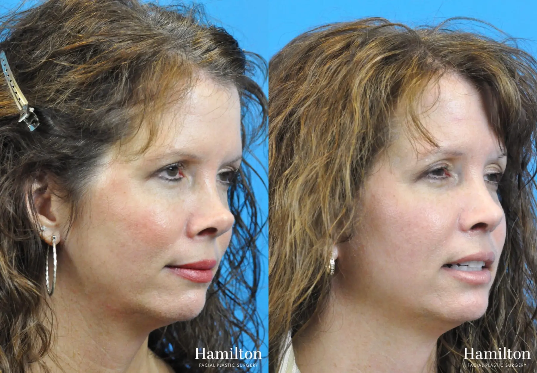 Rhinoplasty: Patient 24 - Before and After 2