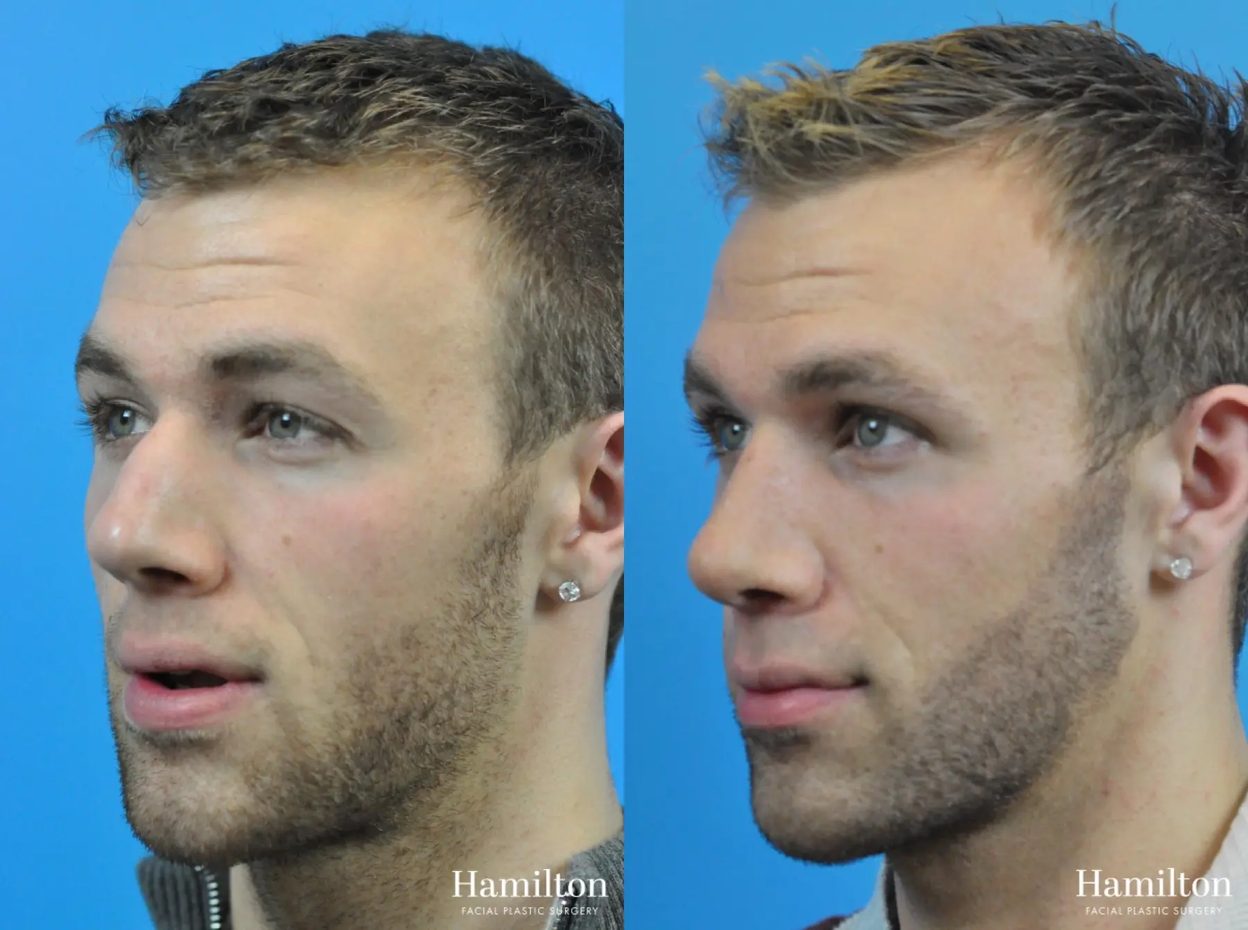 Rhinoplasty: Patient 10 - Before and After 4