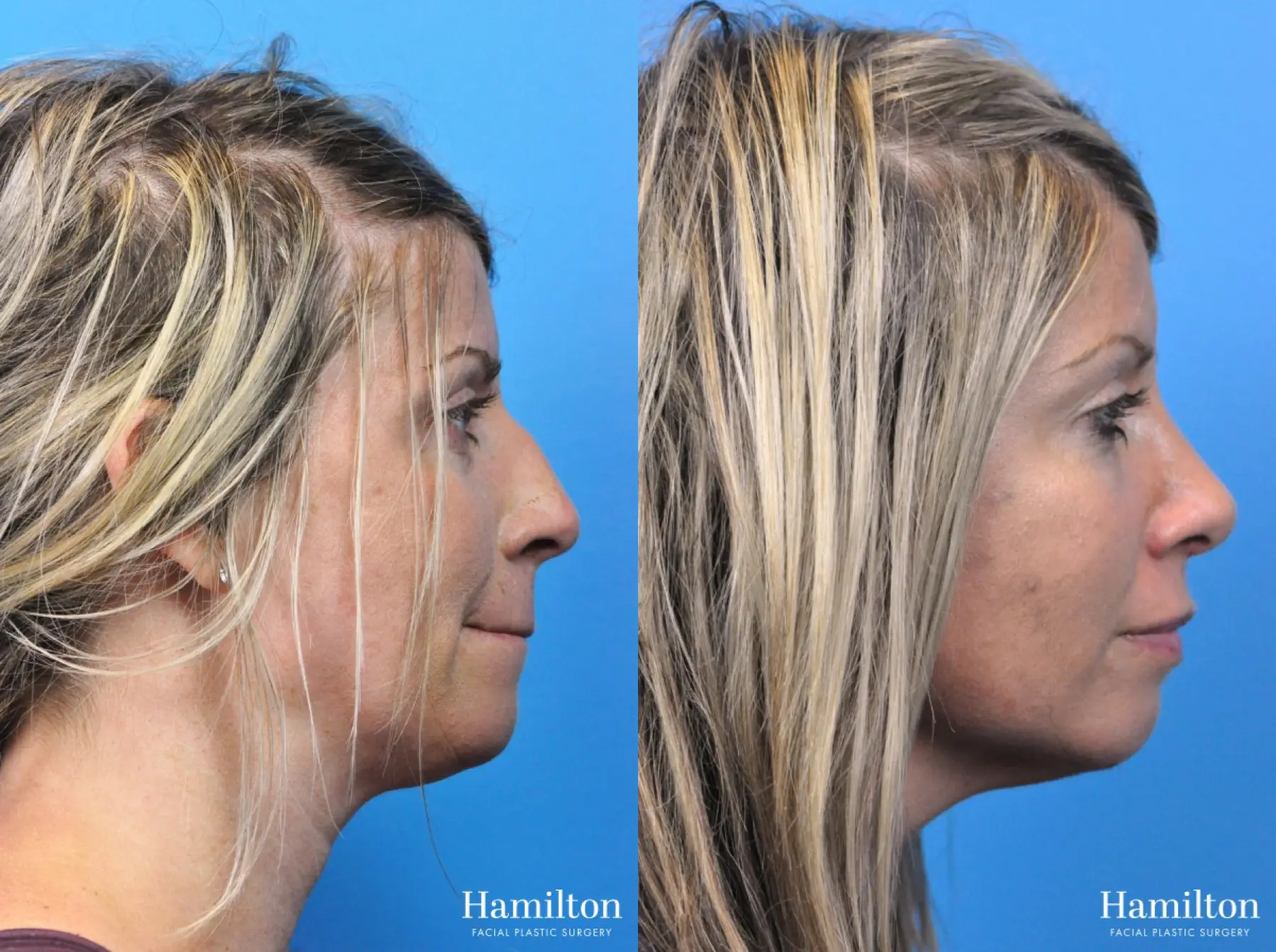 Rhinoplasty: Patient 32 - Before and After 5