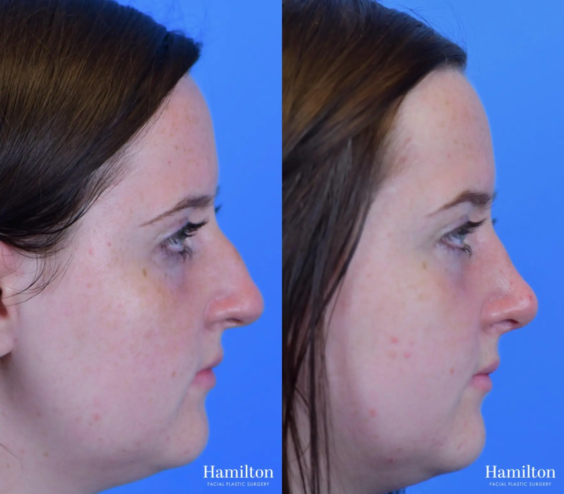 Rhinoplasty: Patient 42 - Before and After 2