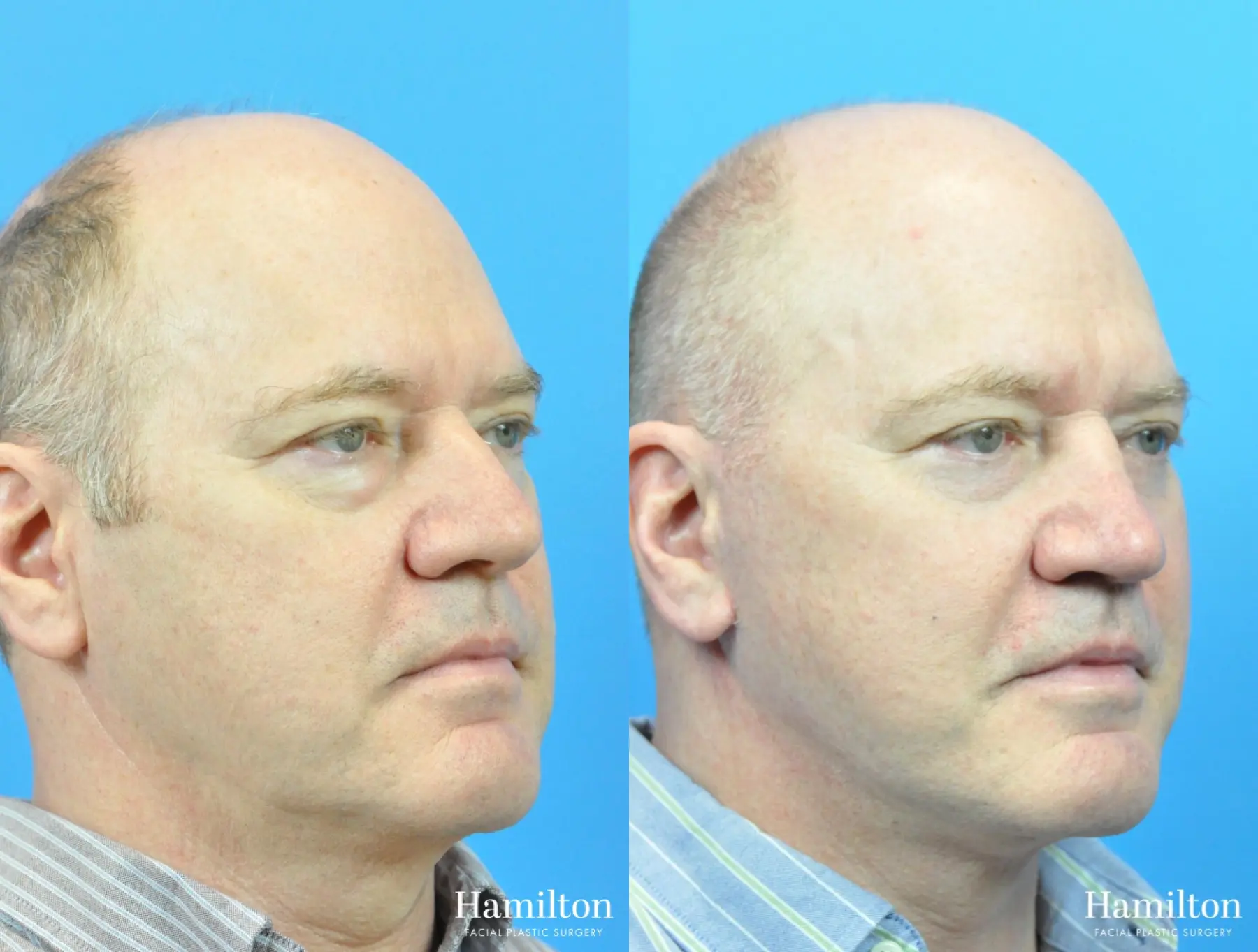 Rhinoplasty: Patient 19 - Before and After 3