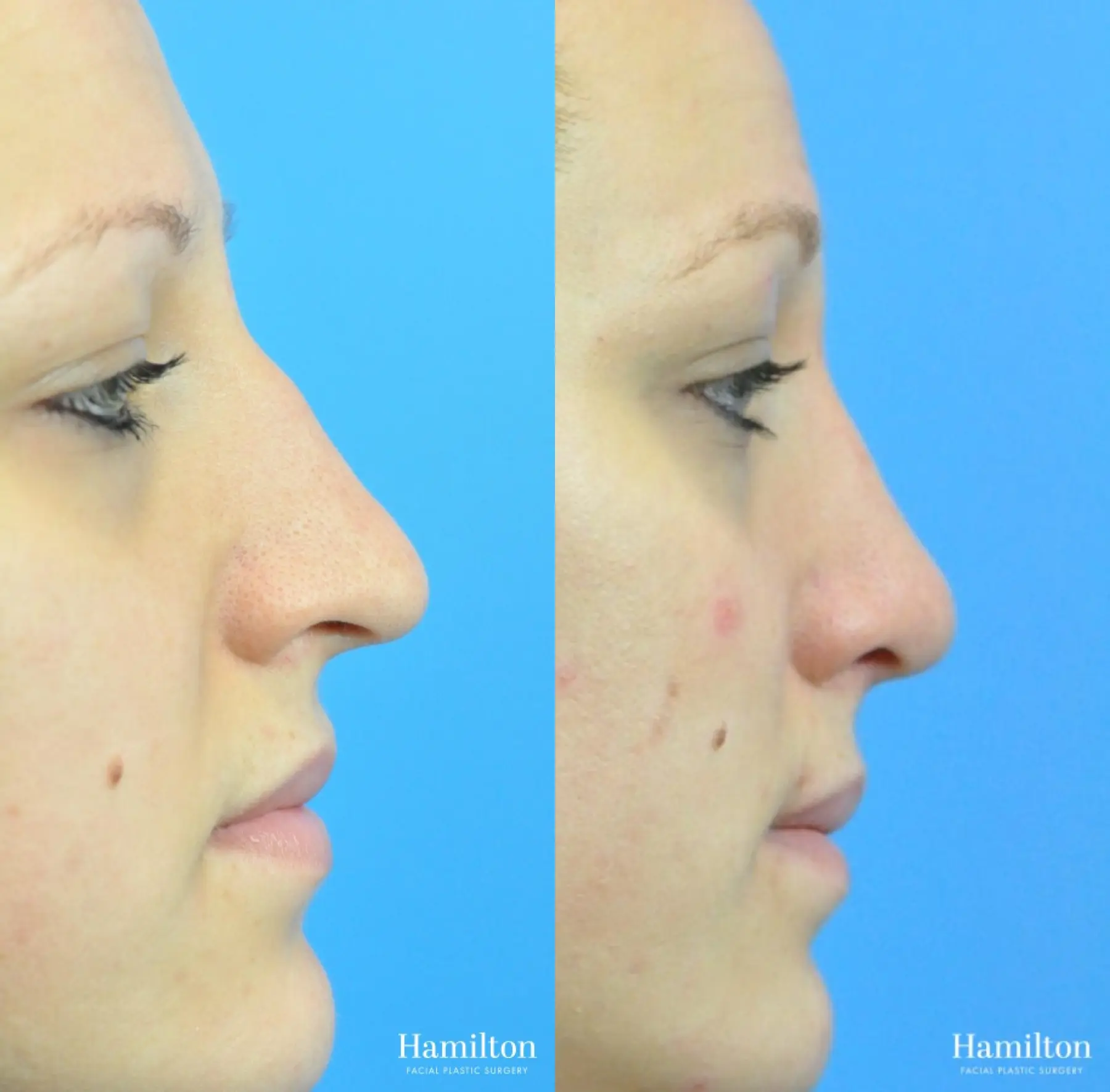 Rhinoplasty: Patient 49 - Before and After 4