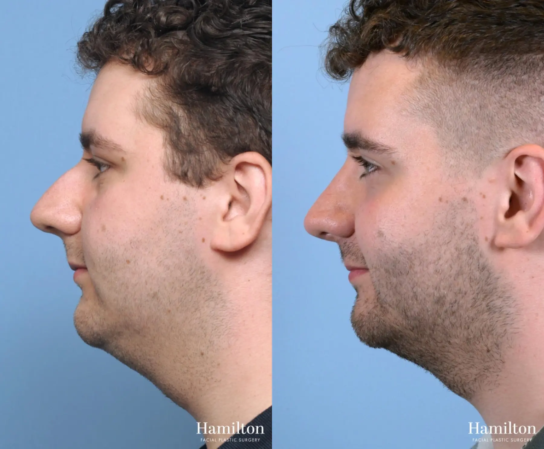 Rhinoplasty: Patient 9 - Before and After 3