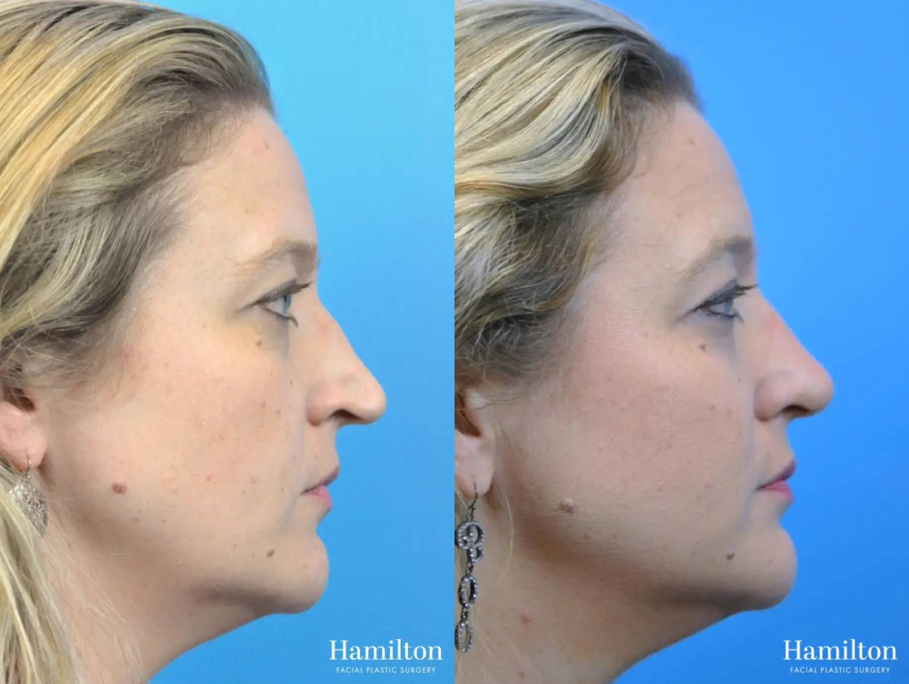 Rhinoplasty: Patient 34 - Before and After 2