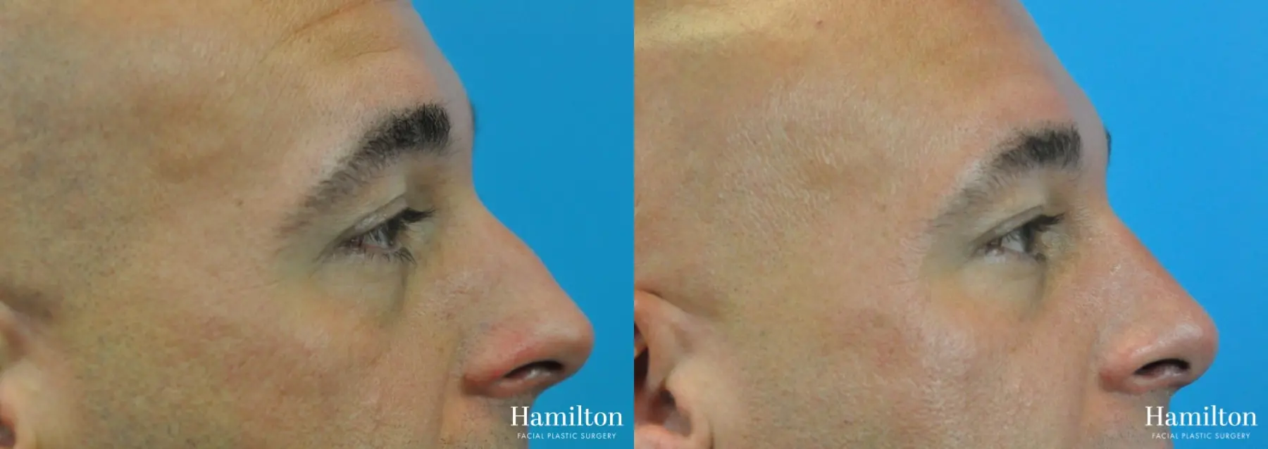 Rhinoplasty: Patient 12 - Before and After 2