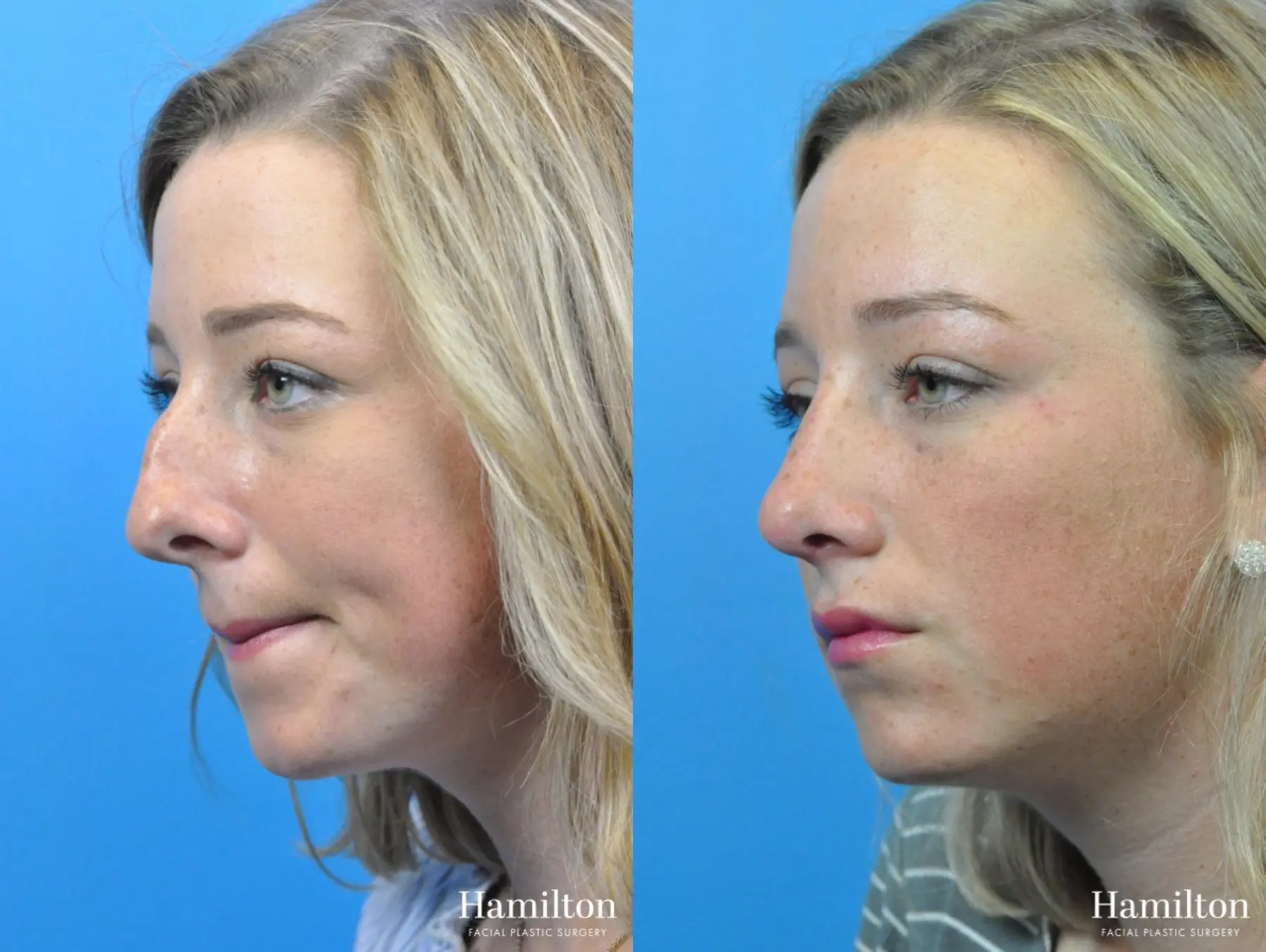 Rhinoplasty: Patient 31 - Before and After 4