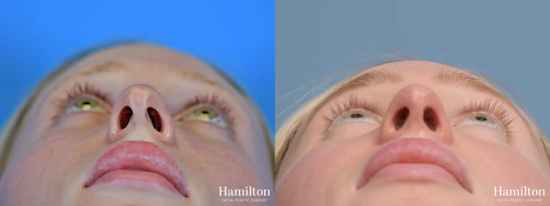 Rhinoplasty: Patient 3 - Before and After 6