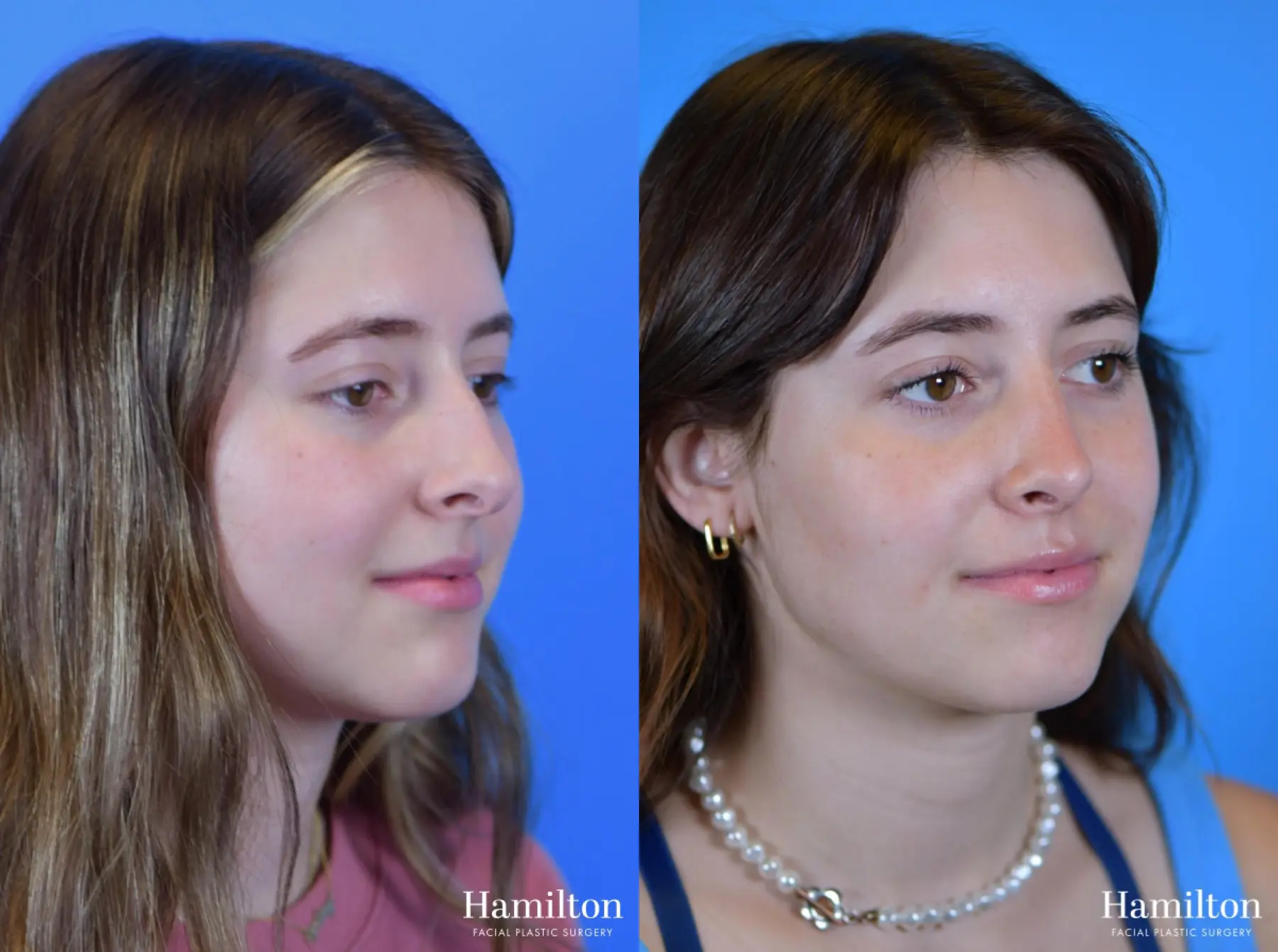 Rhinoplasty: Patient 41 - Before and After 2