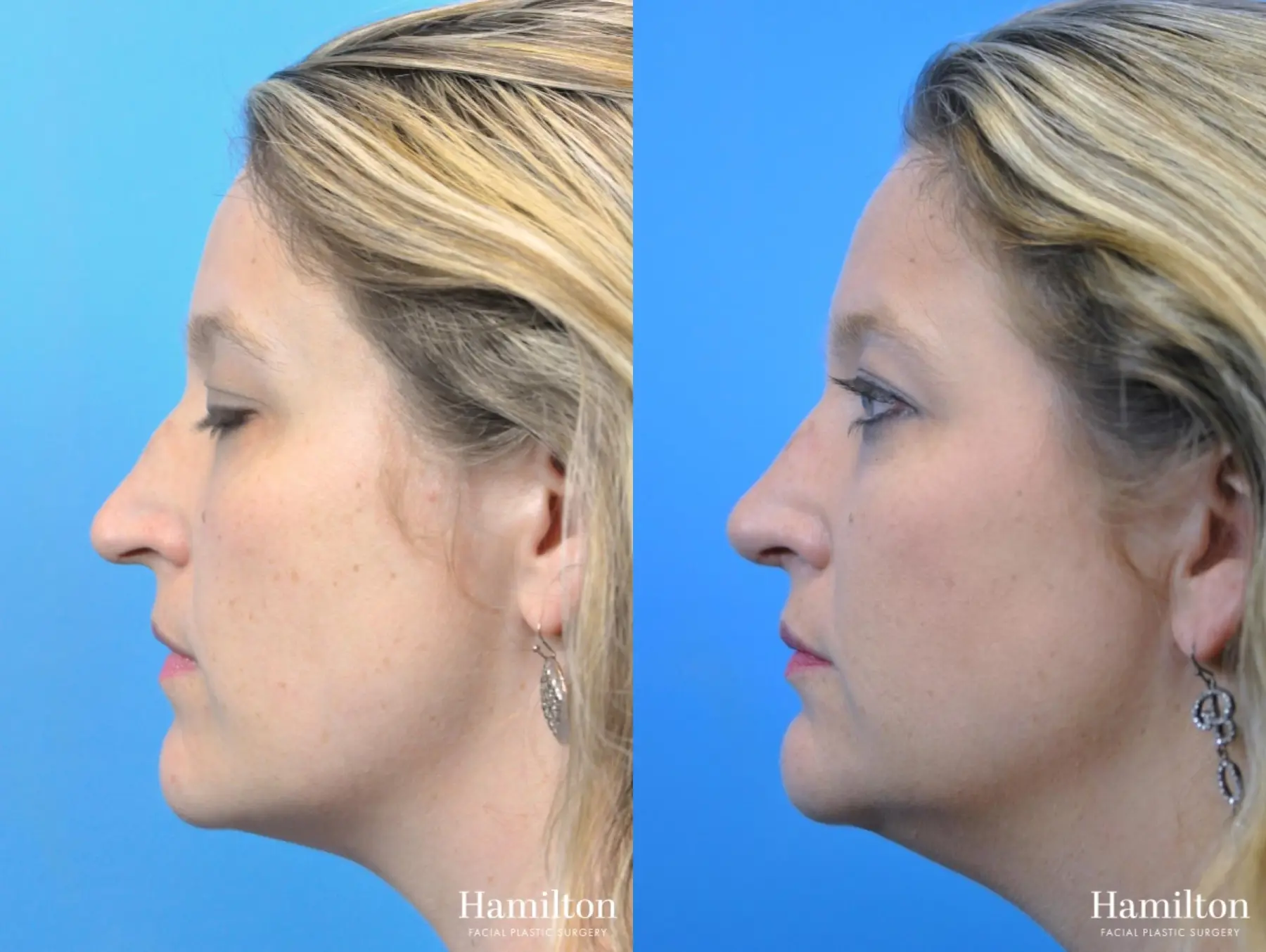 Rhinoplasty: Patient 34 - Before and After 1