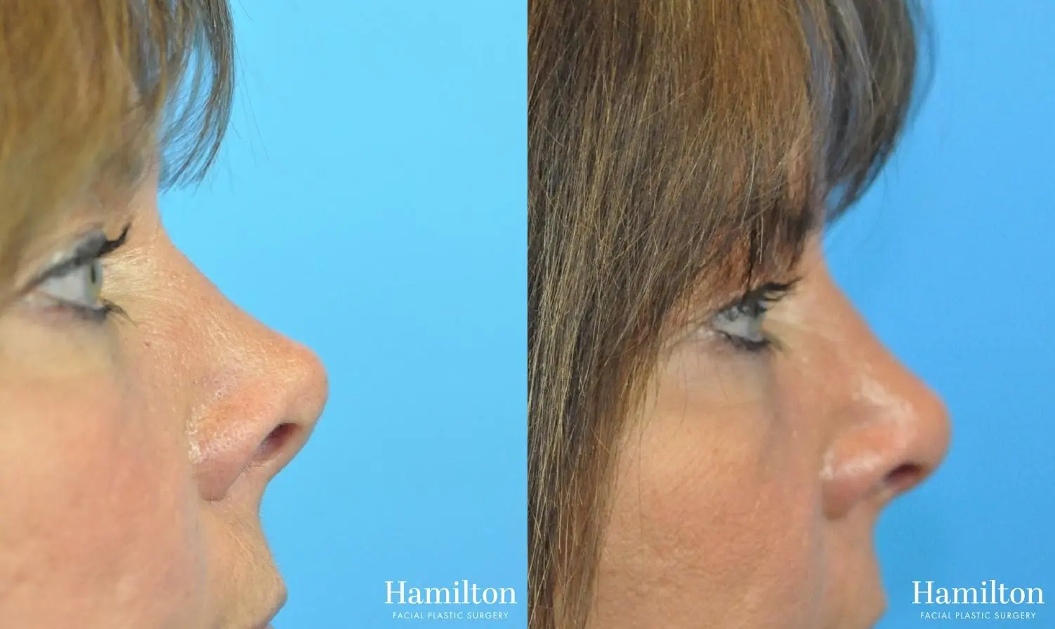 Rhinoplasty: Patient 46 - Before and After 3