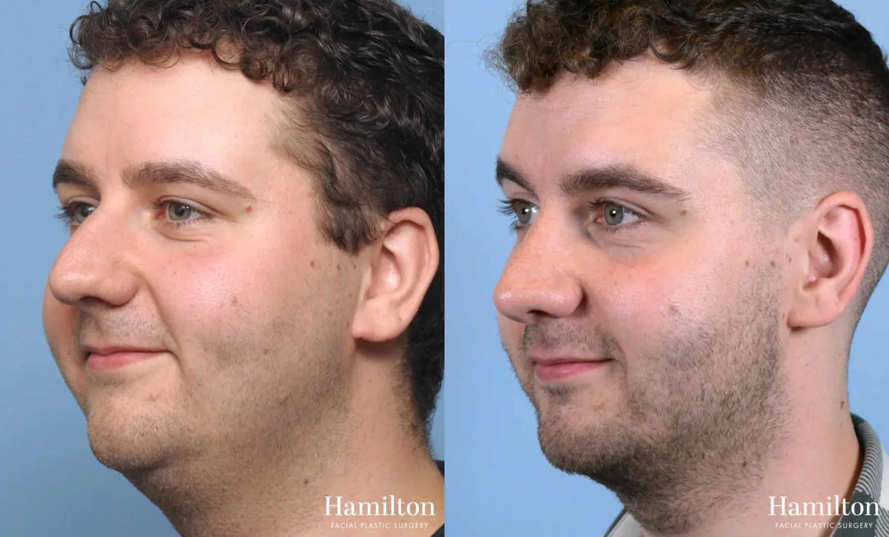 Rhinoplasty: Patient 9 - Before and After 4