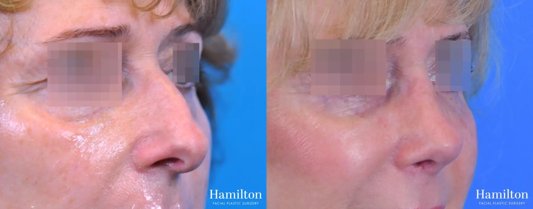 Rhinoplasty: Patient 45 - Before and After 2