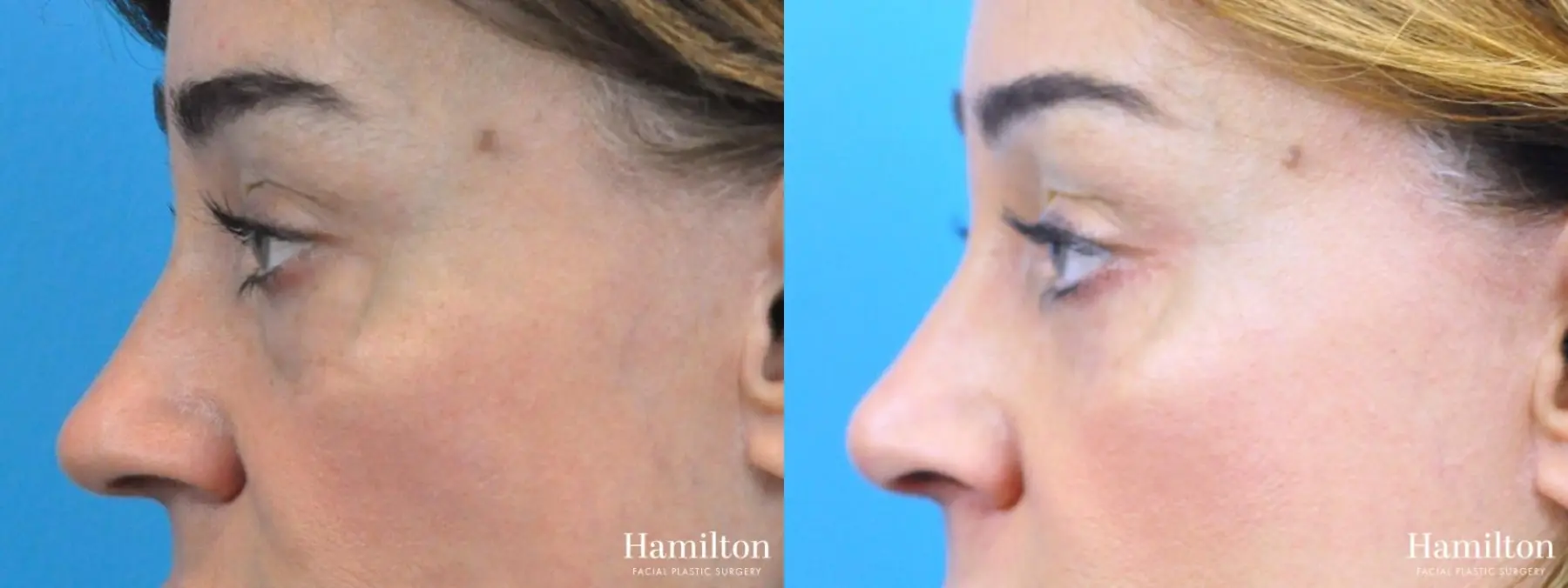 Rhinoplasty: Patient 33 - Before and After 2