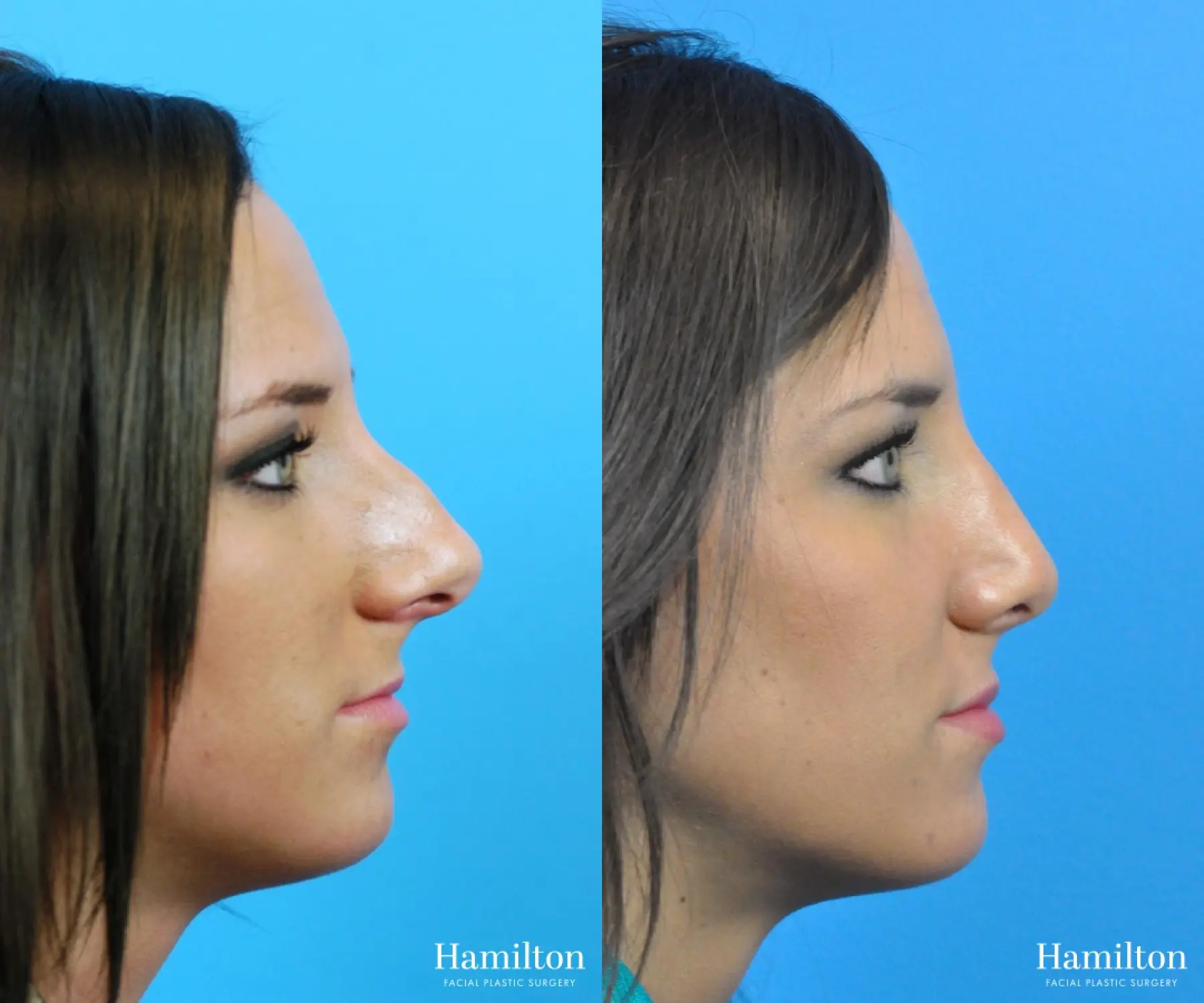 Rhinoplasty Before & After Gallery: Patient 25