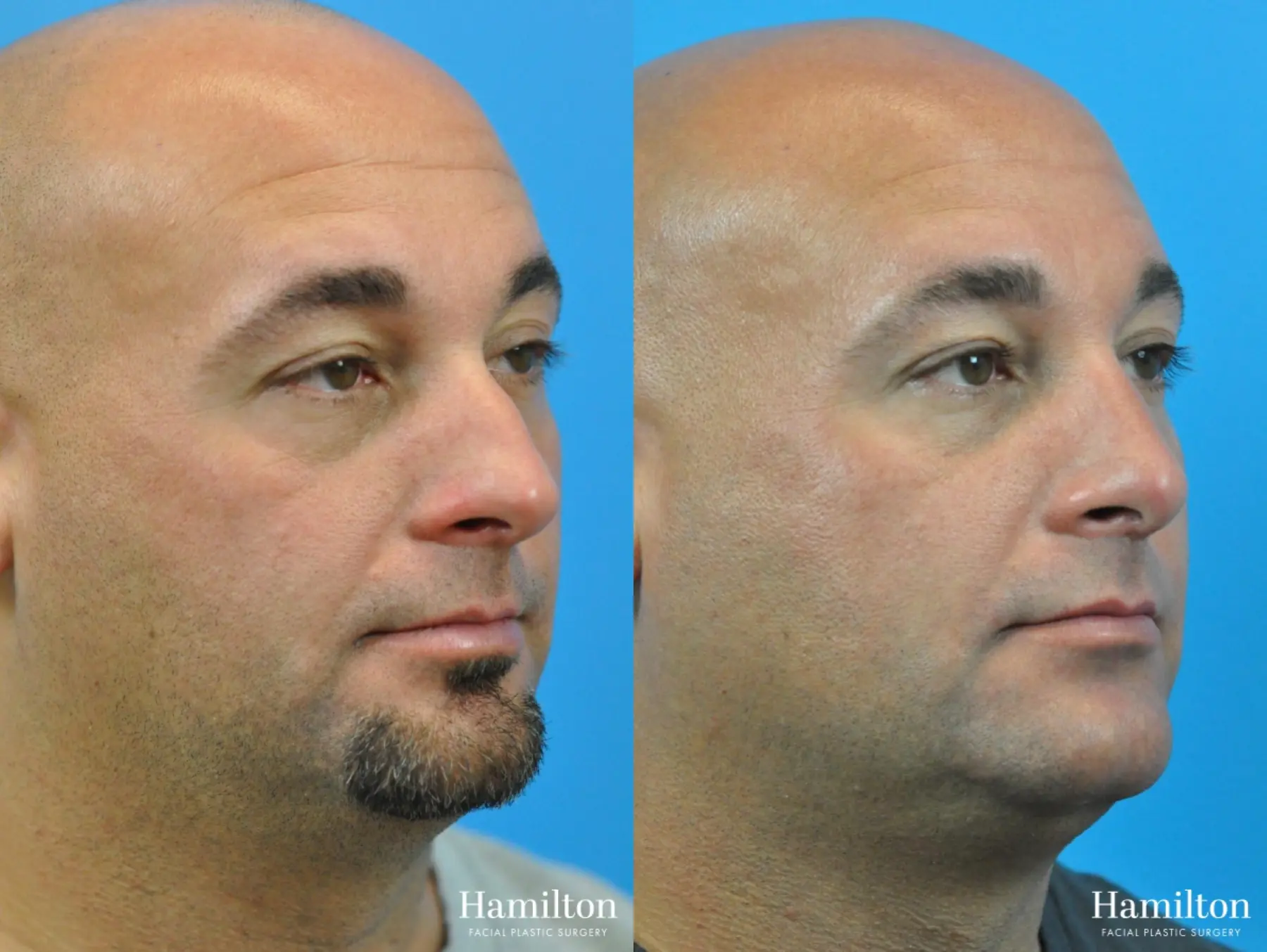 Rhinoplasty: Patient 12 - Before and After 3