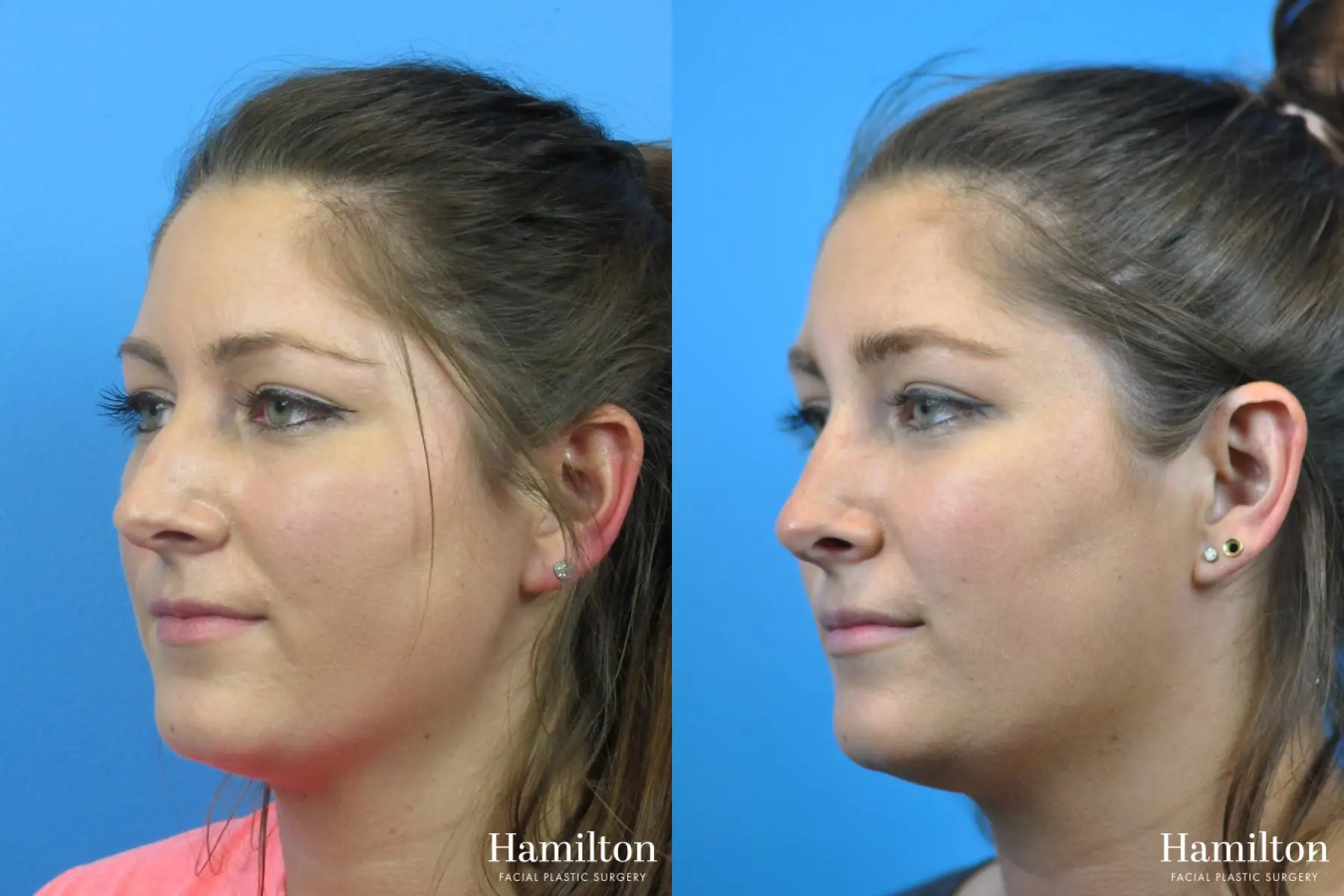 Rhinoplasty: Patient 32 - Before and After 3