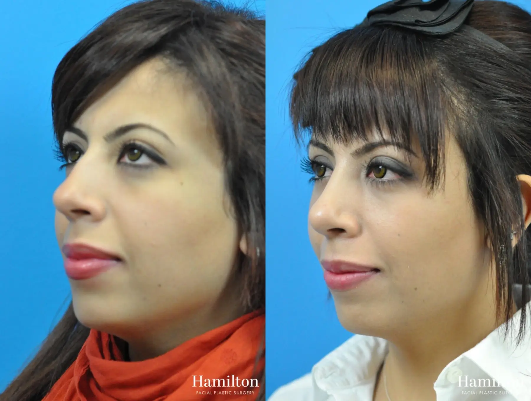 Rhinoplasty: Patient 16 - Before and After 1